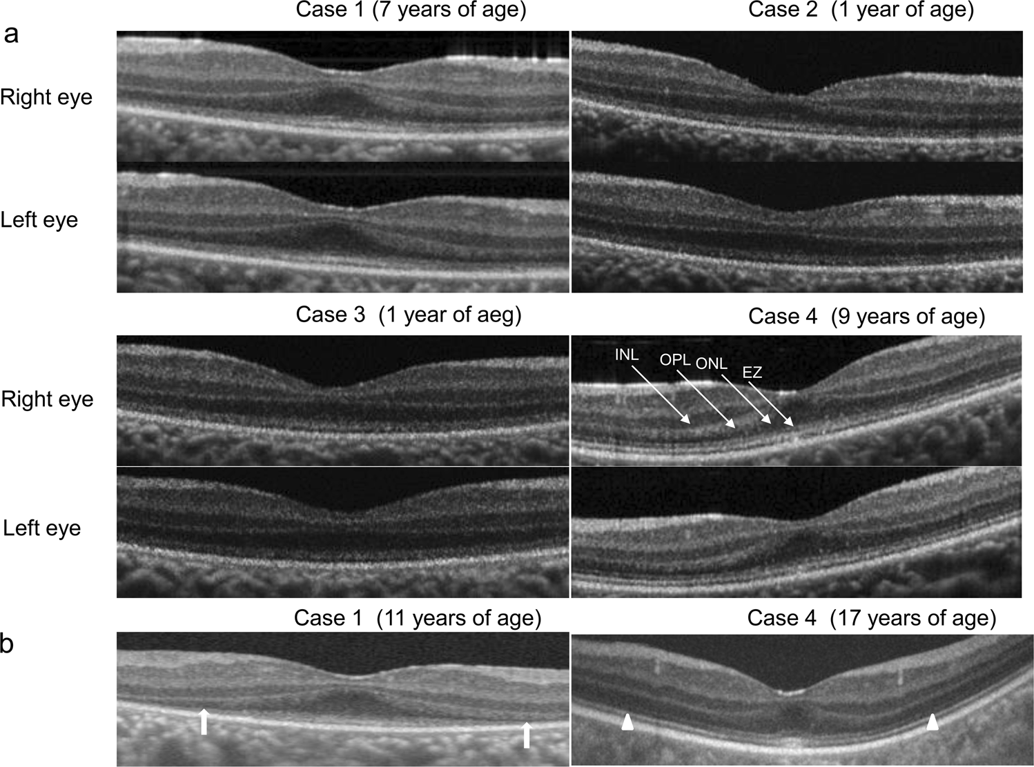 Fig. 4: Optical coherence tomography (OCT) findings for four patients with Leber’s congenital amaurosis (LCA) caused by RPGRIP1 mutations.