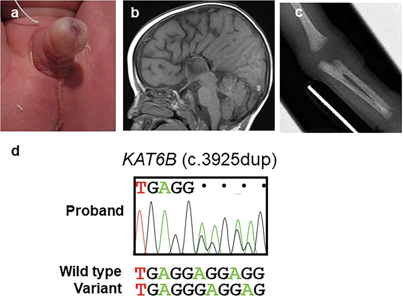 Kat6b Related Disorder In A Patient With A Novel Frameshift Variant C 3925dup Human Genome Variation