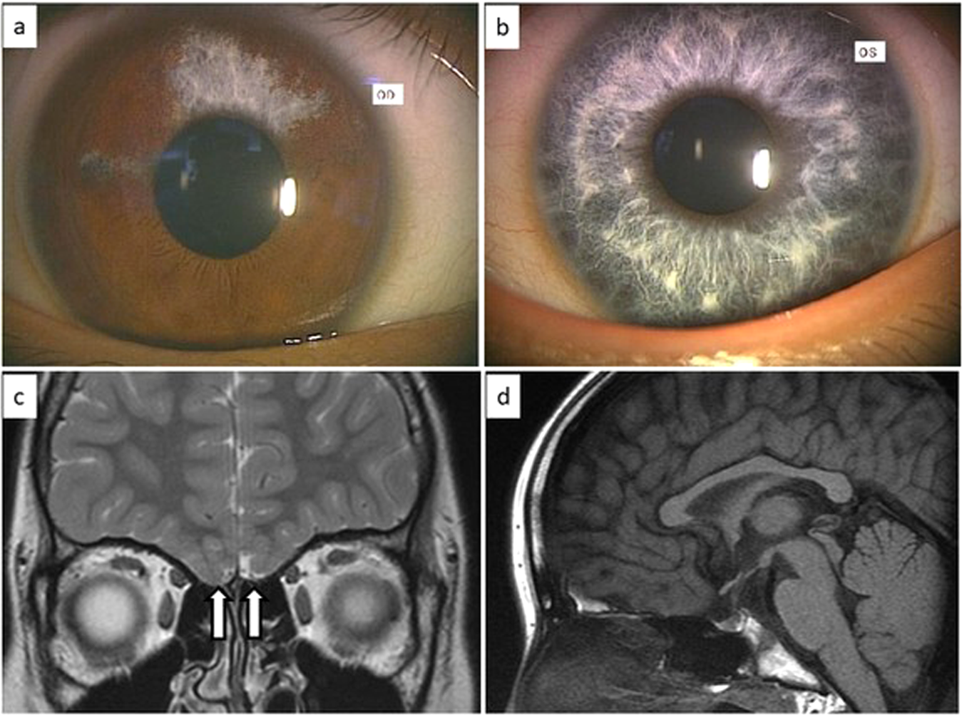A Novel Sox10 Variant In A Japanese Girl With Waardenburg Syndrome Type 4c And Kallmann Syndrome Human Genome Variation