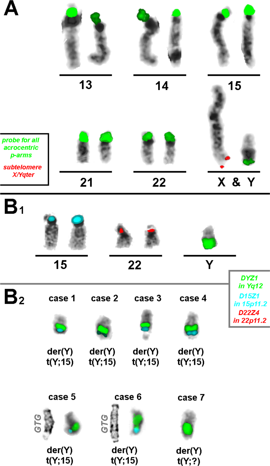The acrocentric part of der(Y)t(Y;acro)(q12;p1?2) contains D15Z1 sequences  in the majority of cases | Human Genome Variation, image size:946x1628