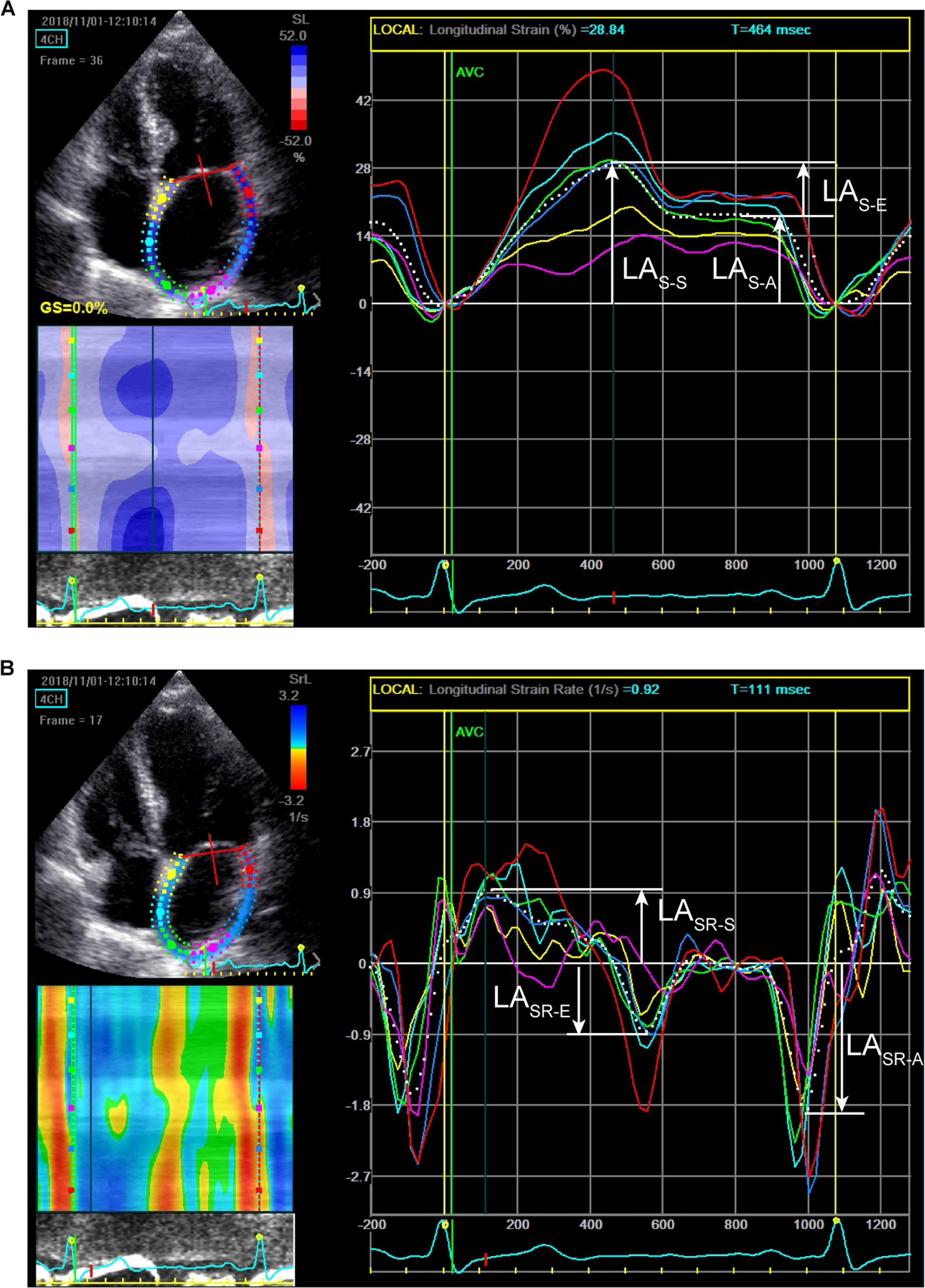 Left atrial strain by speckle-tracking: incremental role in diastolic  assessment of pediatric patients with chronic kidney disease