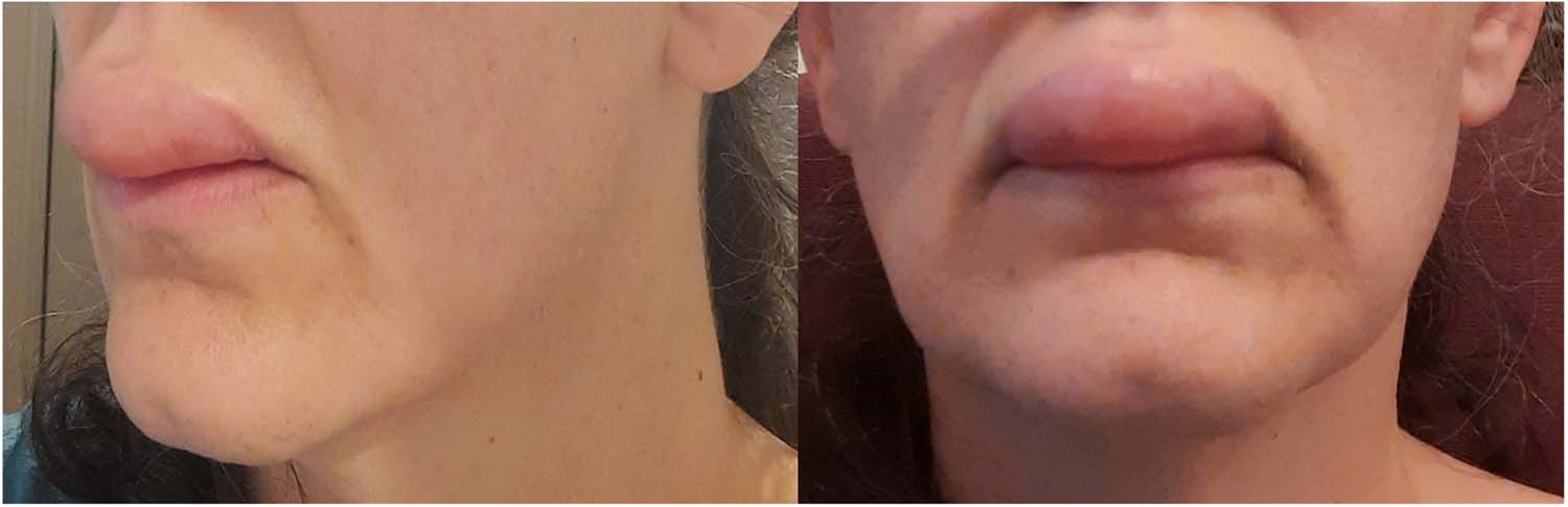 Prediction and prevention of ACE-inhibitor-induced angioedema—an unmet  clinical need in management of hypertension
