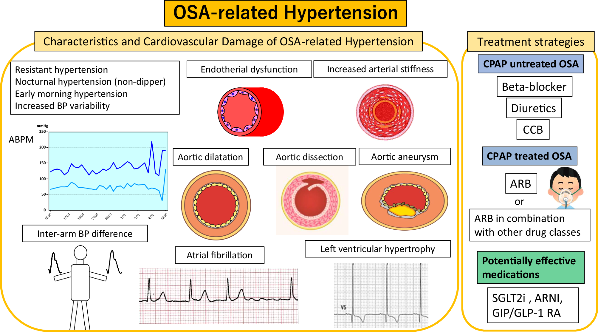 Obstructive sleep apnea  related hypertension a review of the ...