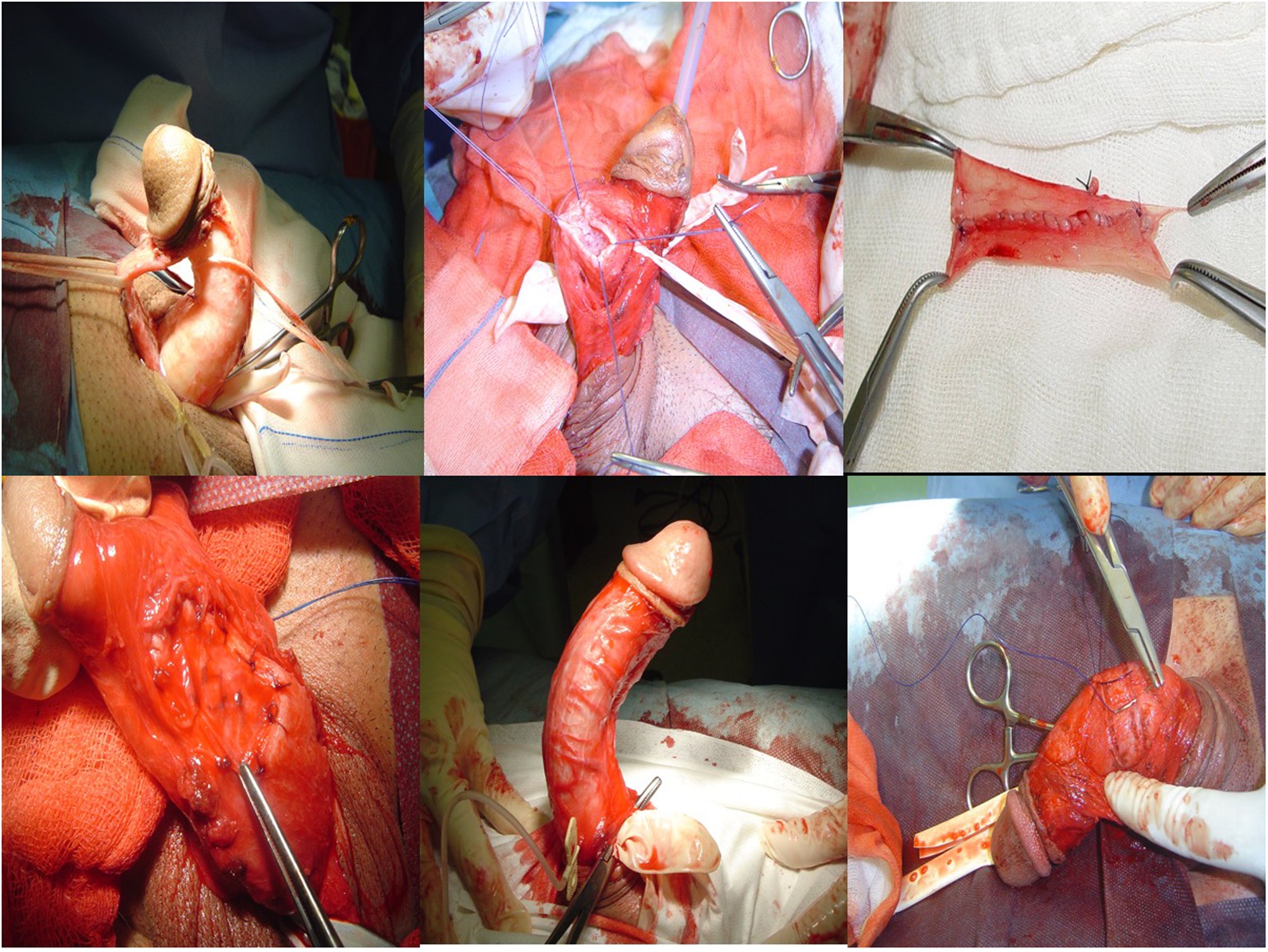 The combination of penile revascularization surgery with penile corrective  techniques as an alternative to prosthesis implantation in patients with  peyronie's disease accompanied by erectile dysfunction: Long-term results |  International Journal of ...