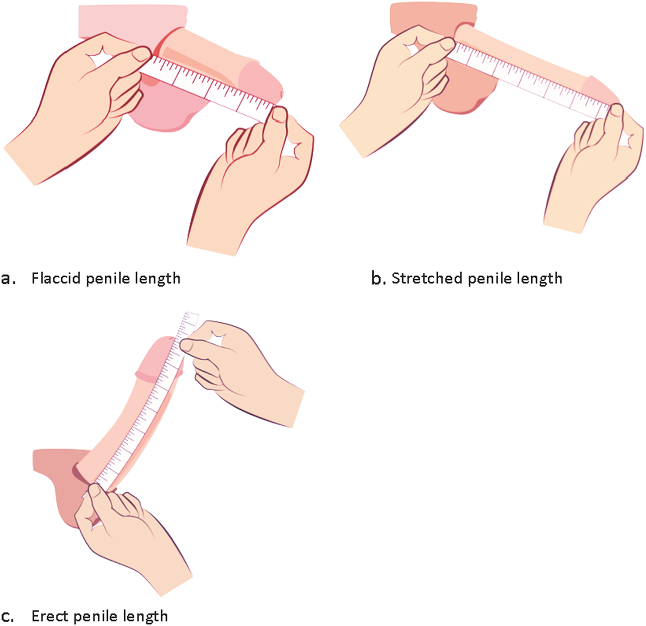 Grower or shower? Predictors of change in penile length from the flaccid to  erect state | International Journal of Impotence Research