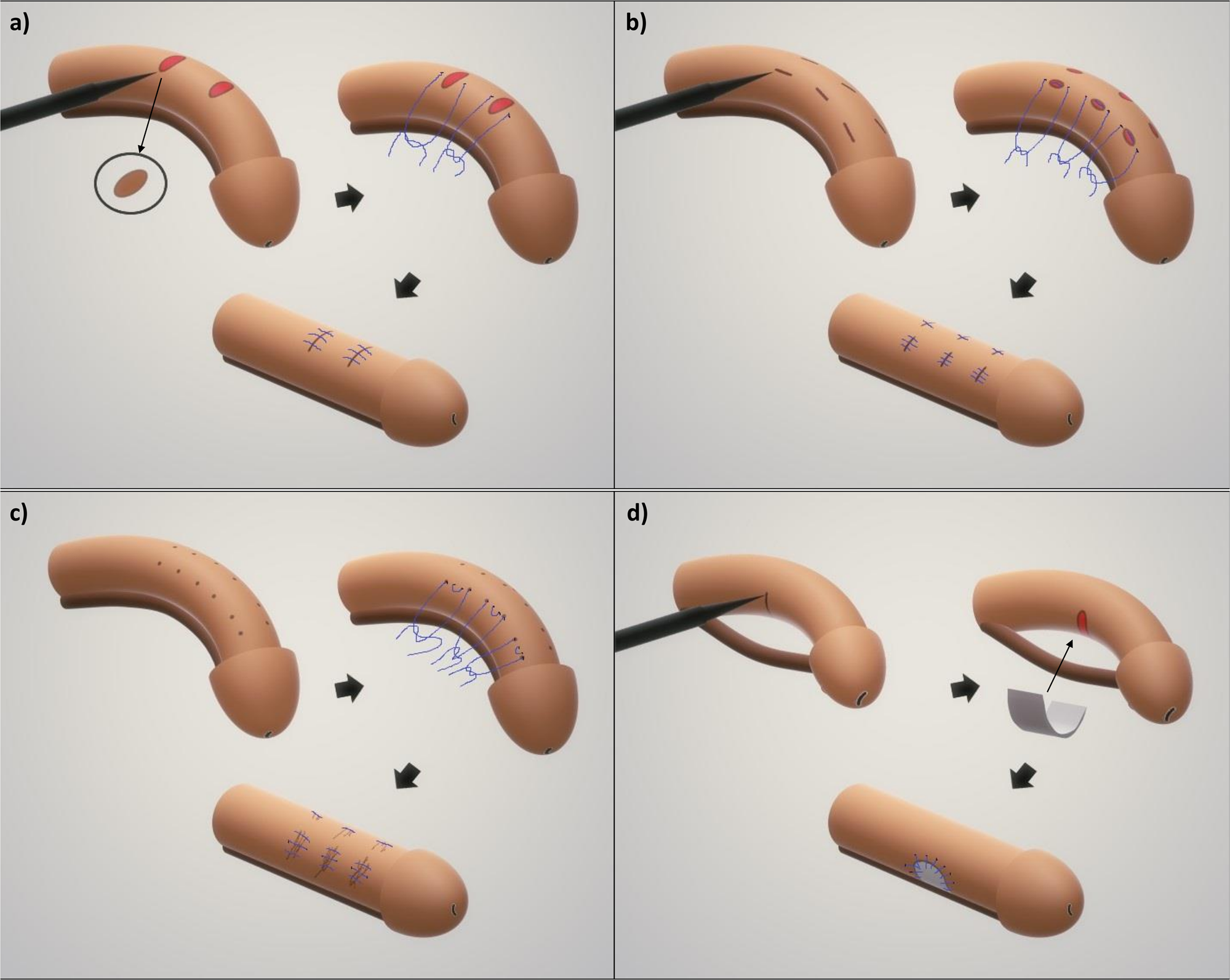 how to correct a curved penis - sartook.ir.