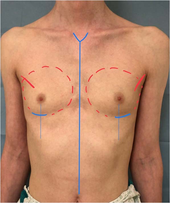 Male-to-female gender affirmation surgery: breast reconstruction with  Ergonomix round prostheses
