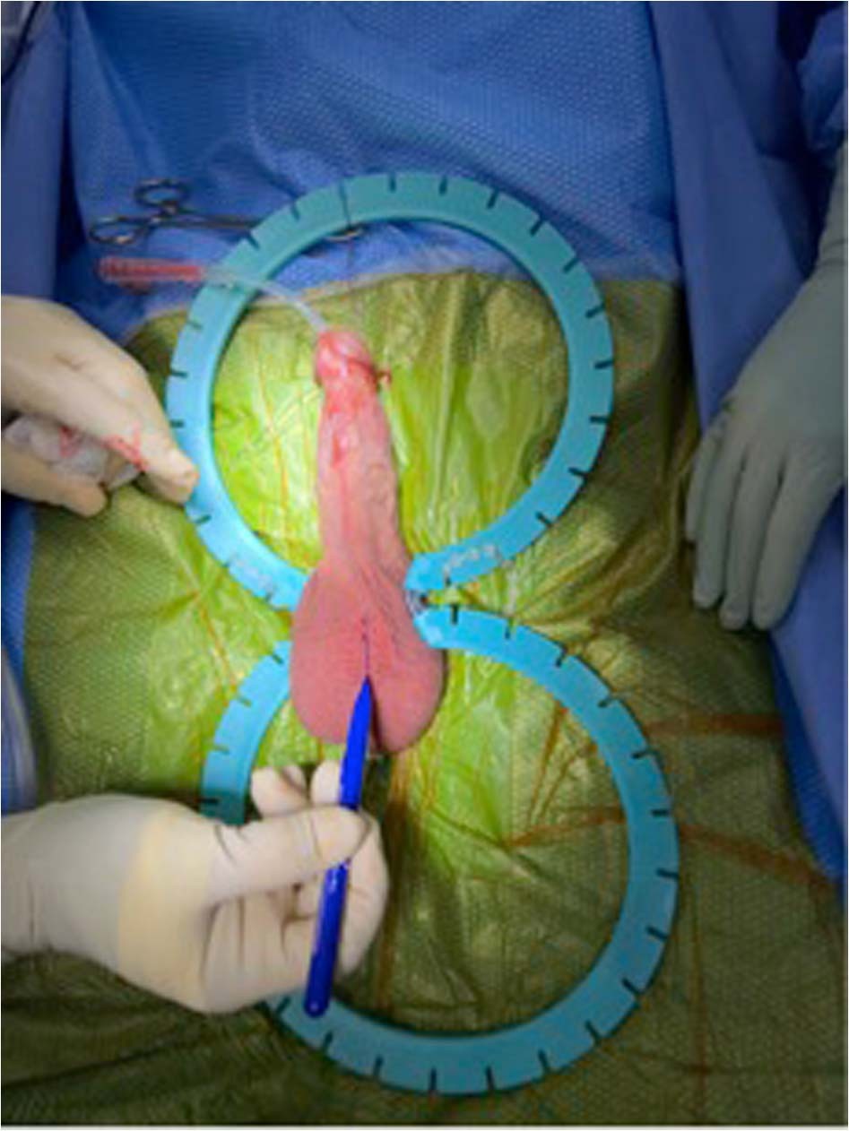 Scrotal approach for tunica expansion procedure (TEP) for penile girth and ...