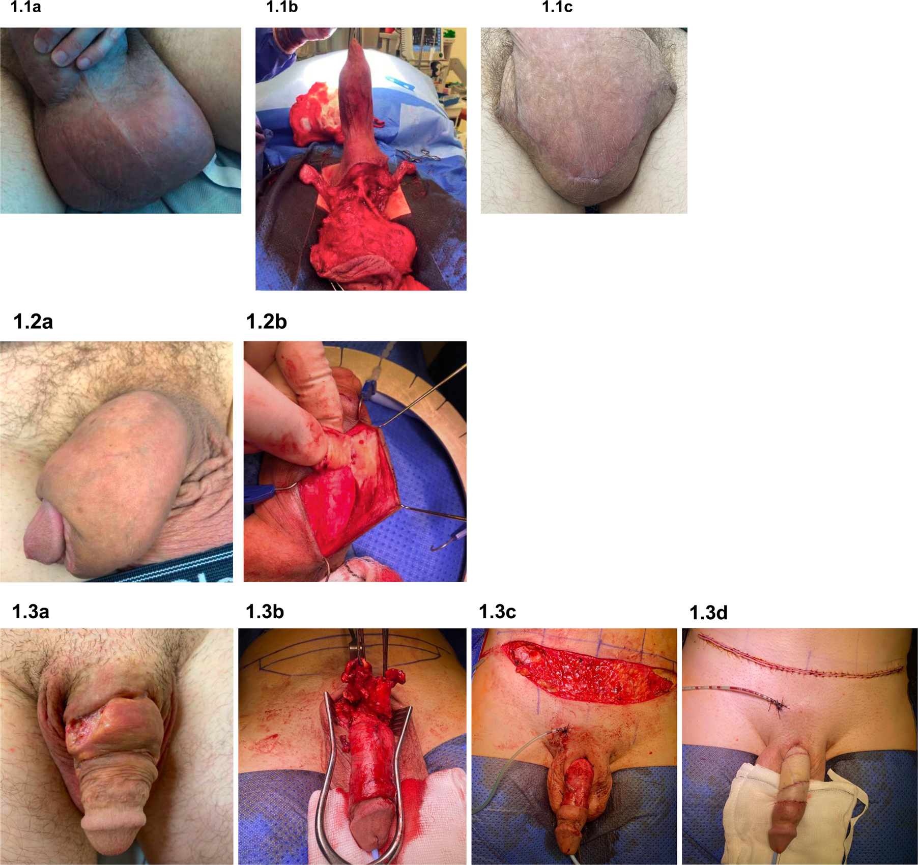 Complications and outcomes following injection of foreign material into the male external genitalia for augmentation a single-centre experience and systematic review International Journal of Impotence Research image picture