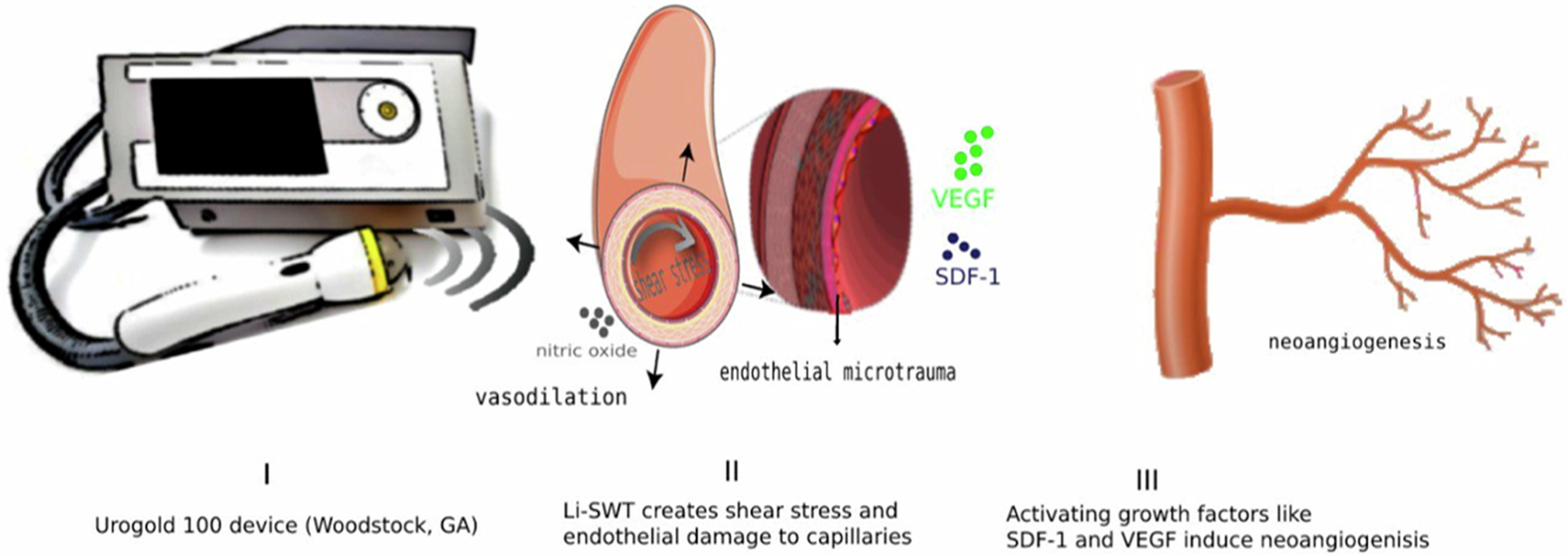 Successful treatment of hard flaccid syndrome with multimodal therapy: a  case report study | International Journal of Impotence Research