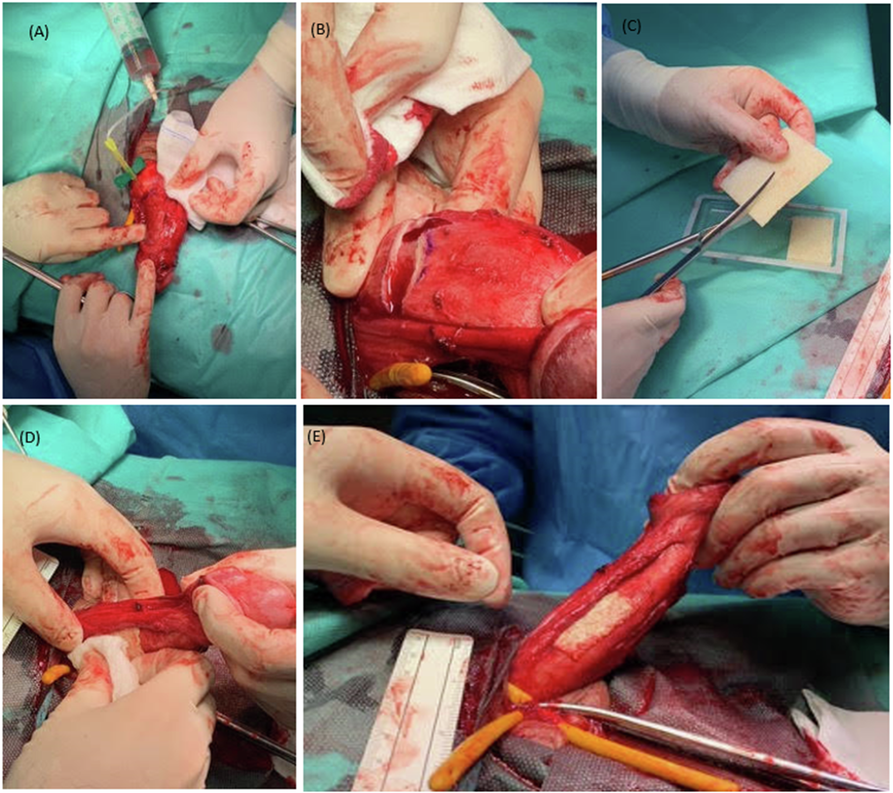Fig. 1: Summary of lengthening corporoplasty with TachoSil®.