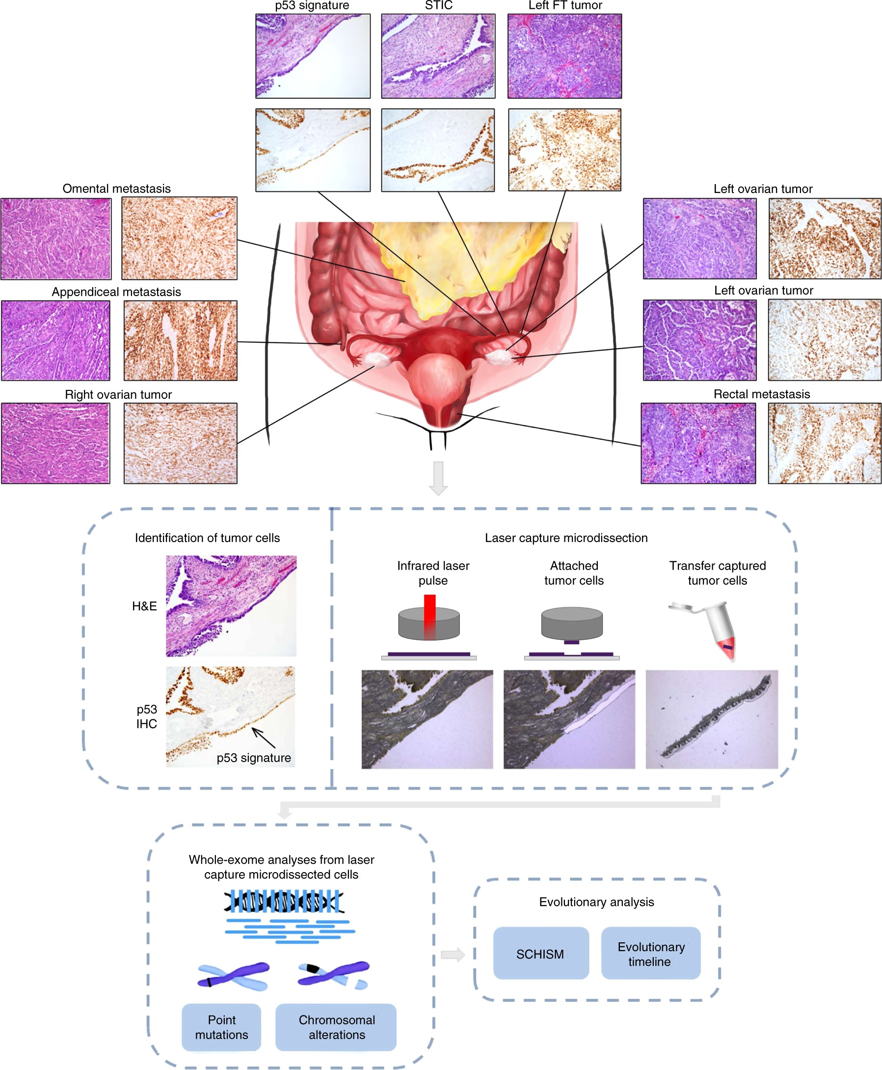 High grade serous ovarian carcinomas originate in the fallopian