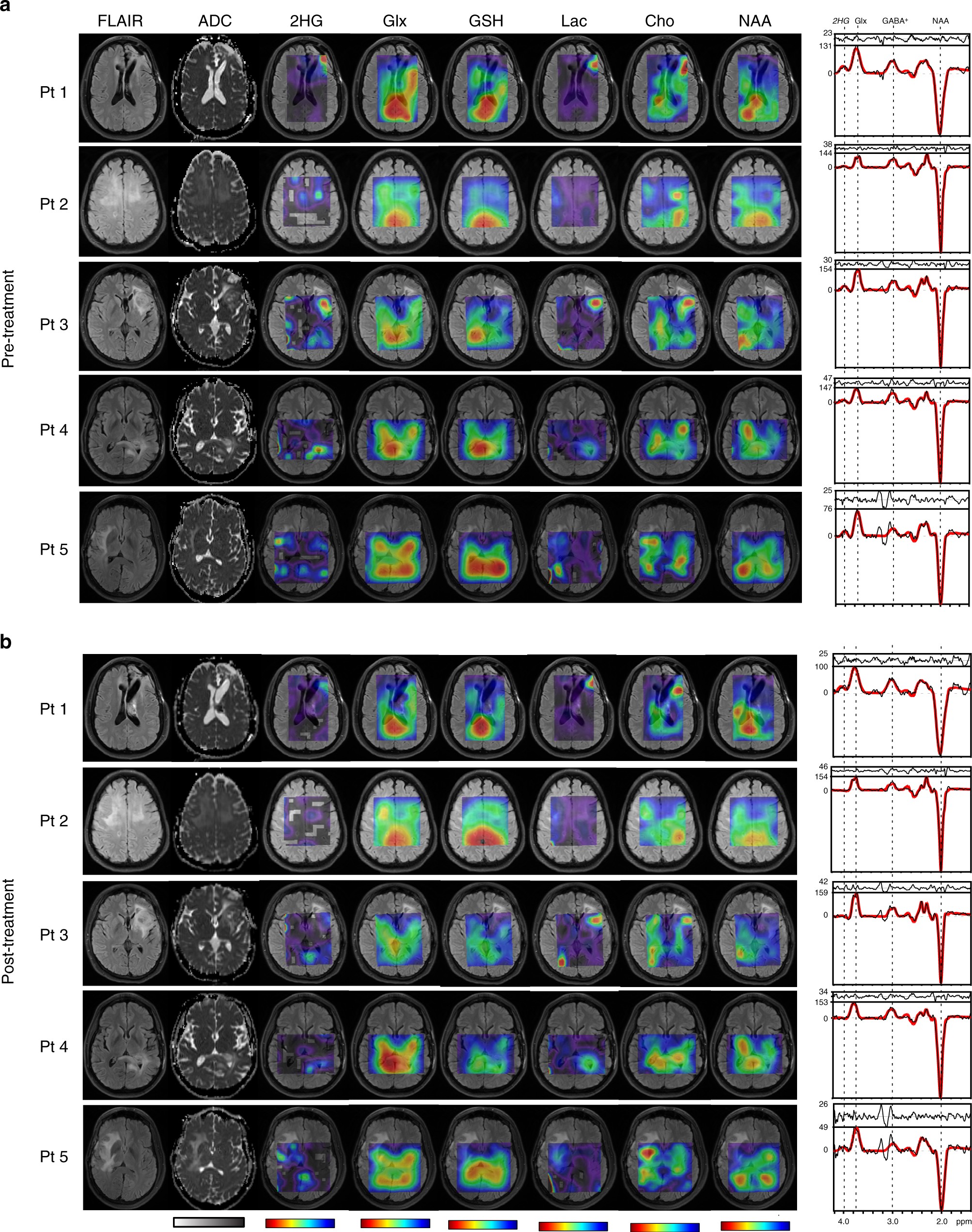 Pharmacodynamics of mutant-IDH1 inhibitors in glioma patients probed by in vivo 3D MRS imaging of 2-hydroxyglutarate | Nature Communications Pharmacodynamics of mutant-IDH1 inhibitors in glioma patients probed by in vivo 3D MRS imaging of 2-hydroxyglutarate | Nature Communications