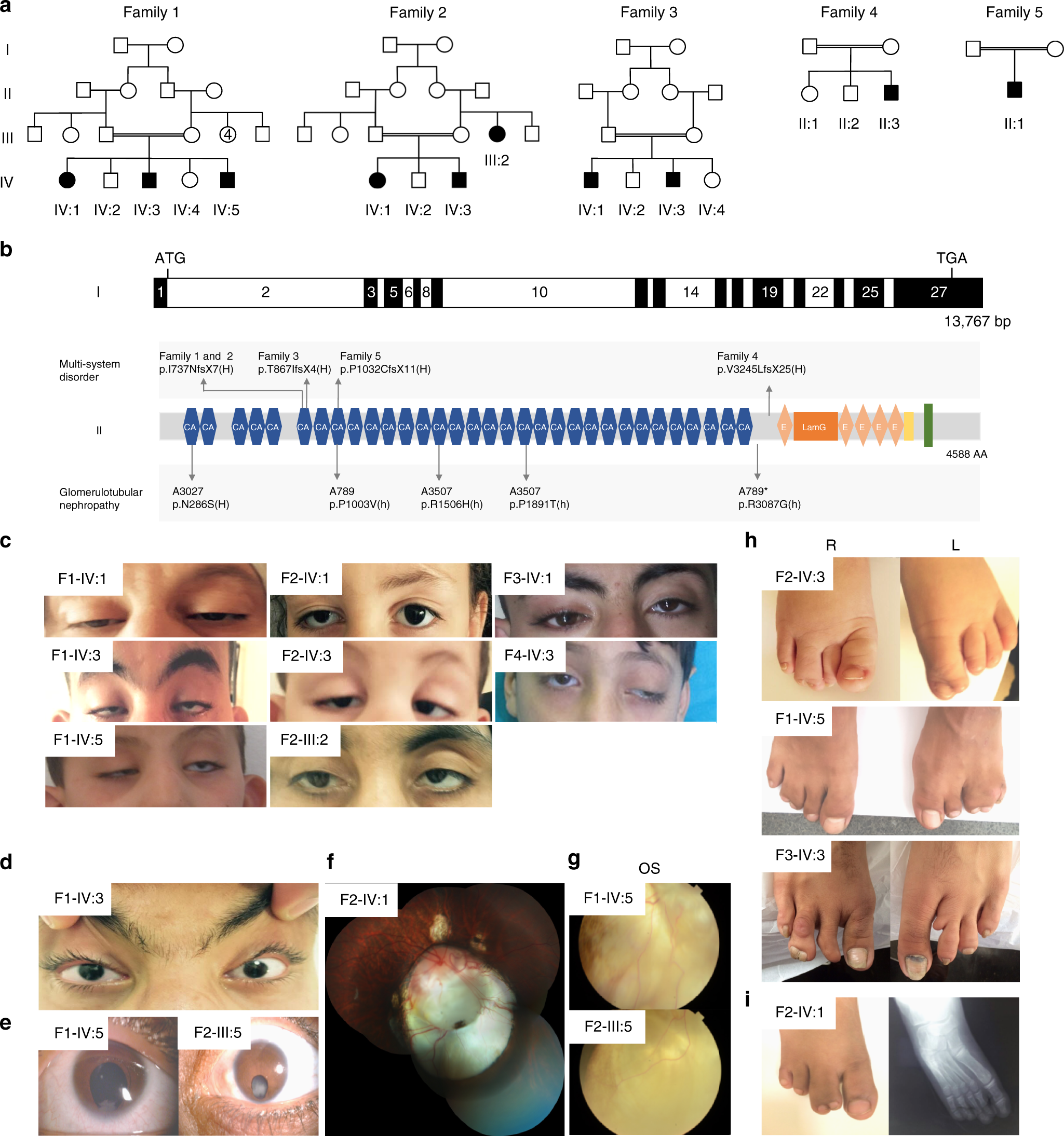 Homozygous frameshift mutations in FAT1 cause a syndrome characterized by  colobomatous-microphthalmia, ptosis, nephropathy and syndactyly | Nature  Communications