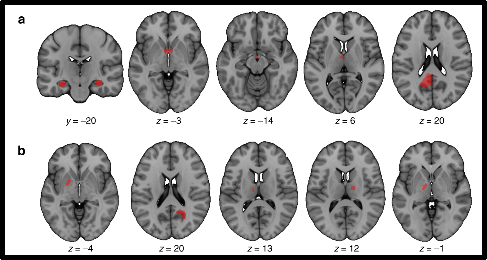 A human memory circuit derived from brain lesions causing amnesia | Nature  Communications