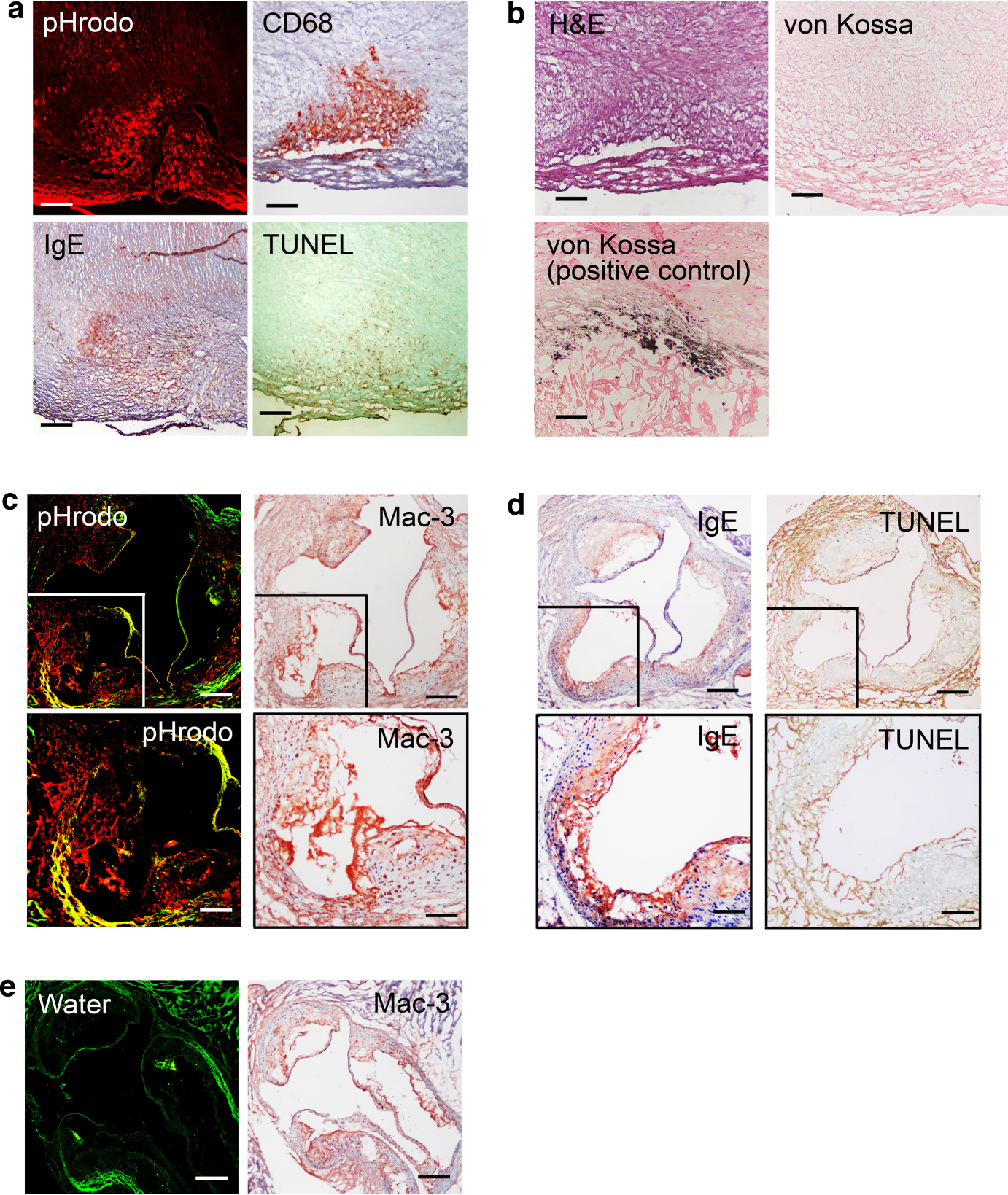 A Definition of Advanced Types of Atherosclerotic Lesions and a  Histological Classification of Atherosclerosis