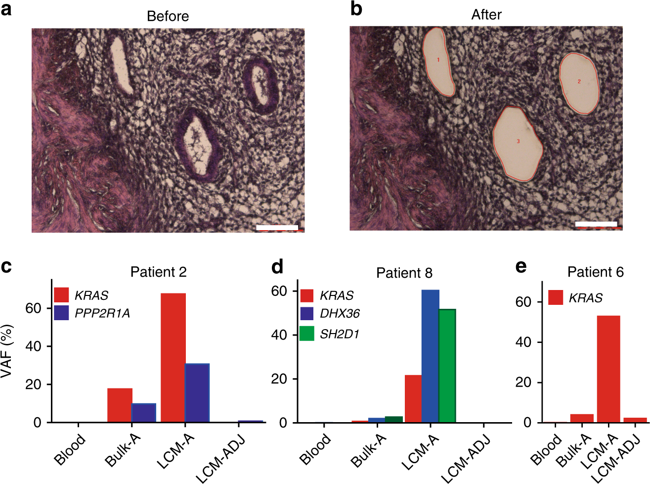 Fig. 2: Somatic mutations in the epithelial component of adenomyosis lesions.