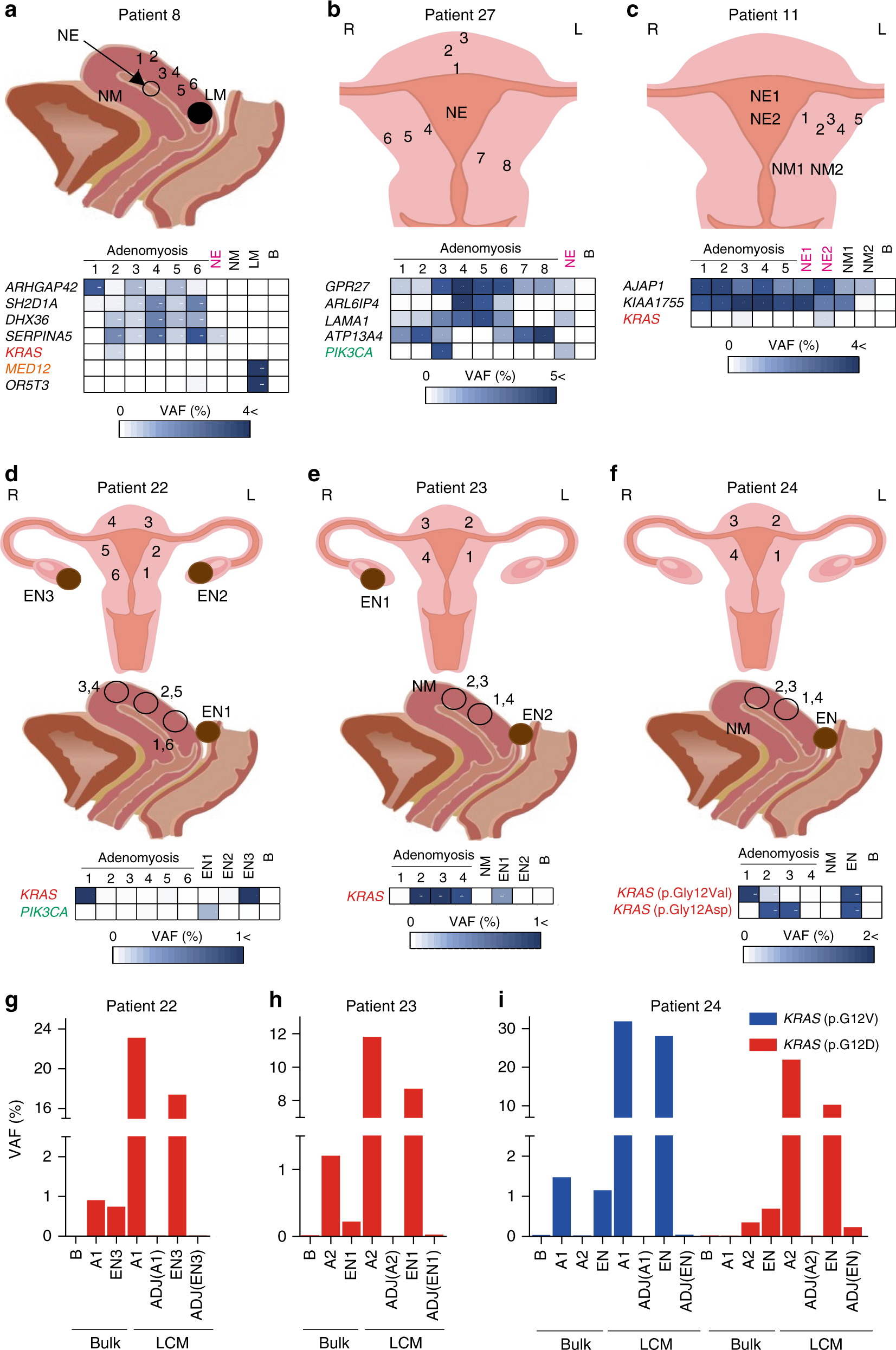 Fig. 4: Multi-regional sampling reveals shared mutations in adenomyosis, endometriosis, and adjacent normal endometrium.