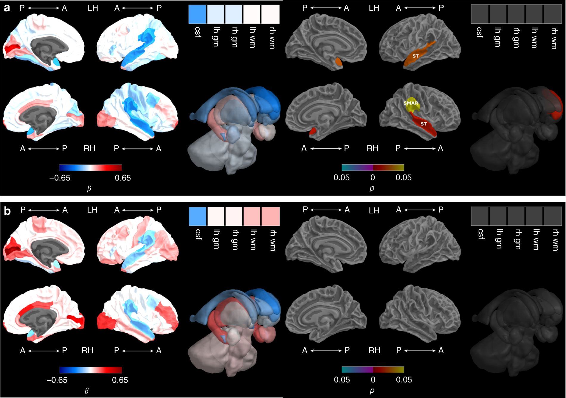Fig. 3: Growth restriction and brain growth from term-equivalent to 7 years.
