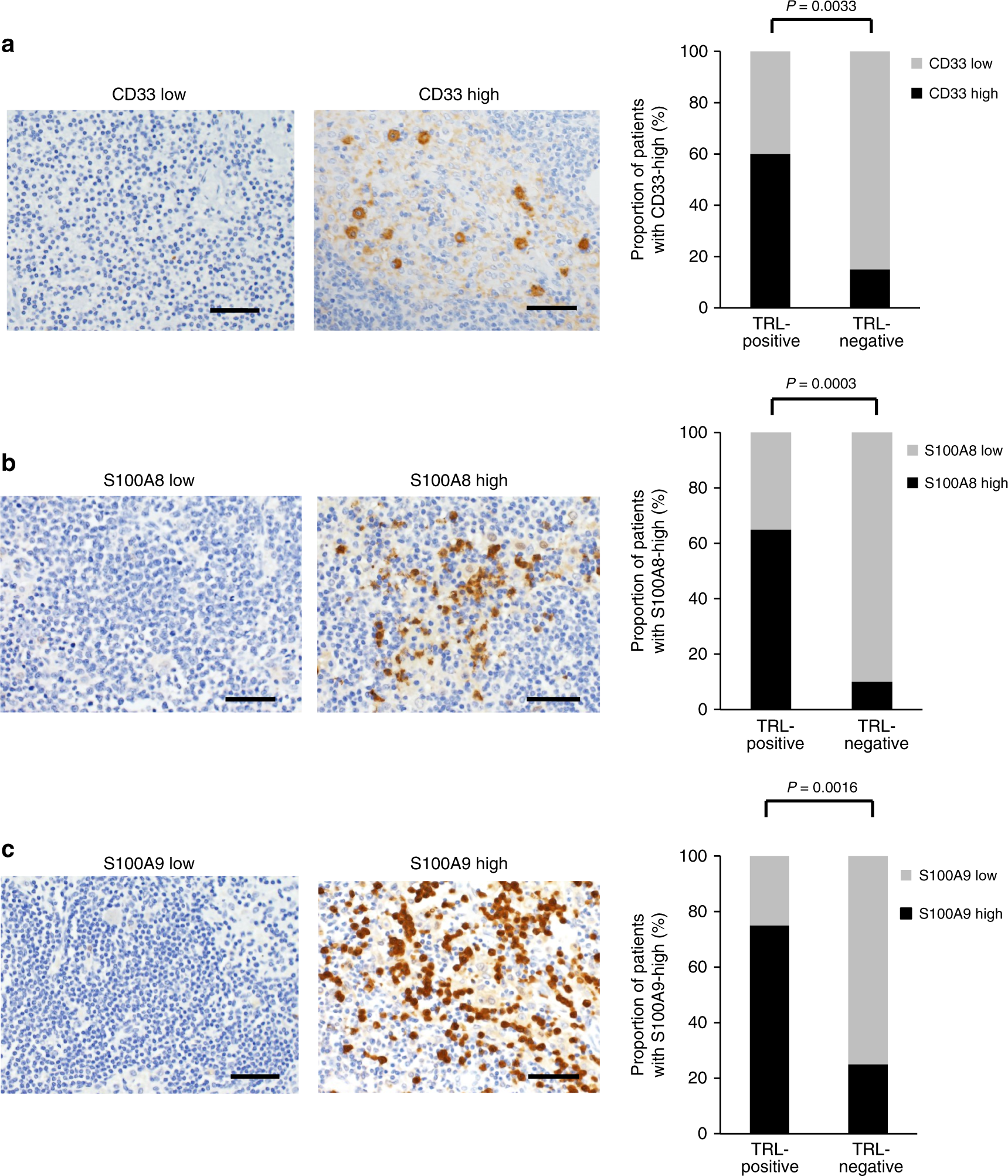Fig. 5: Immunoreactivities of resected lymph nodes for CD33 and S100A8/9 in cervical cancer patients TRL-positive versus TRL-negative patients.