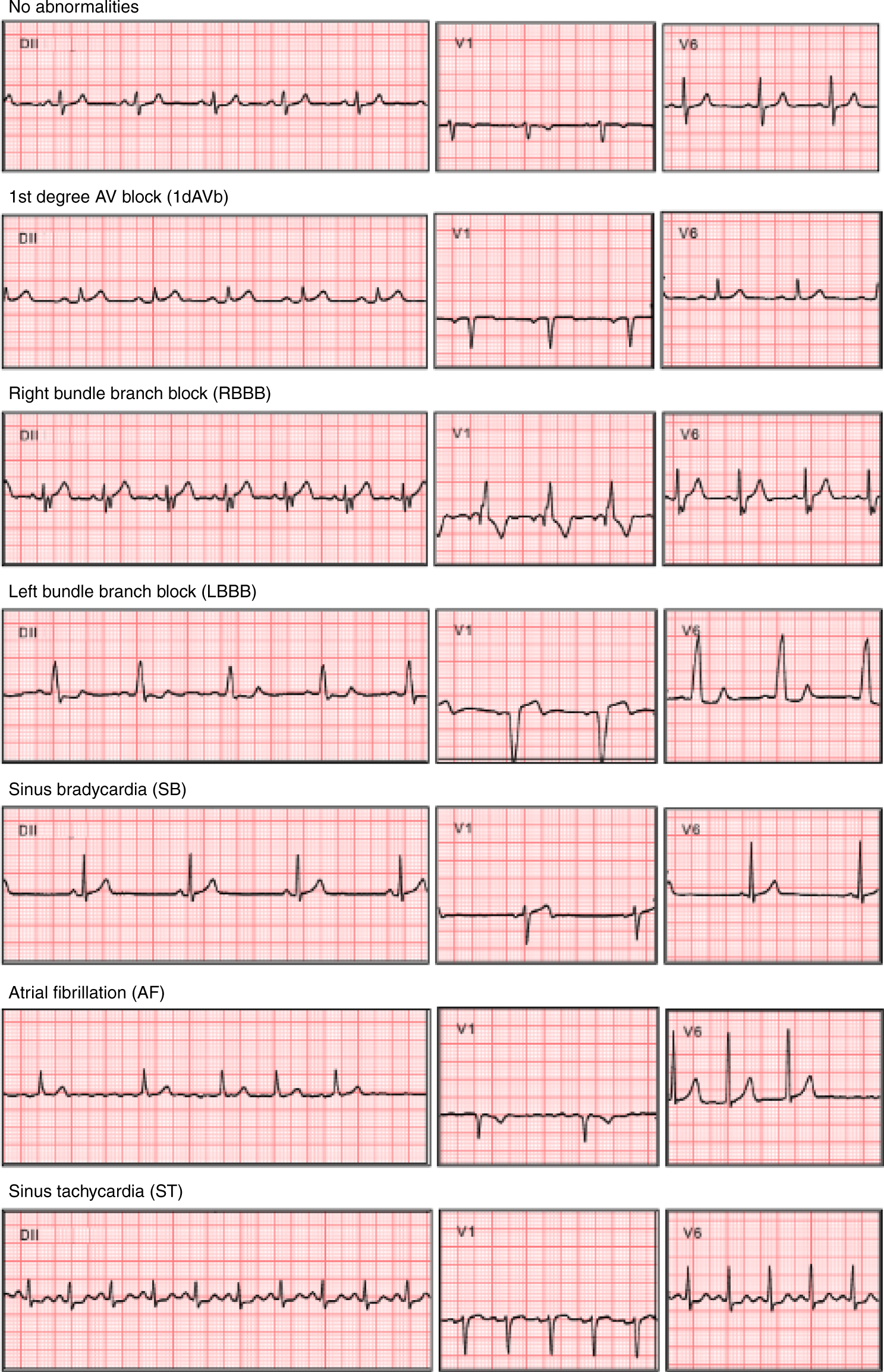 Automatic diagnosis of the 12-lead ECG using a deep neural network | Nature  Communications