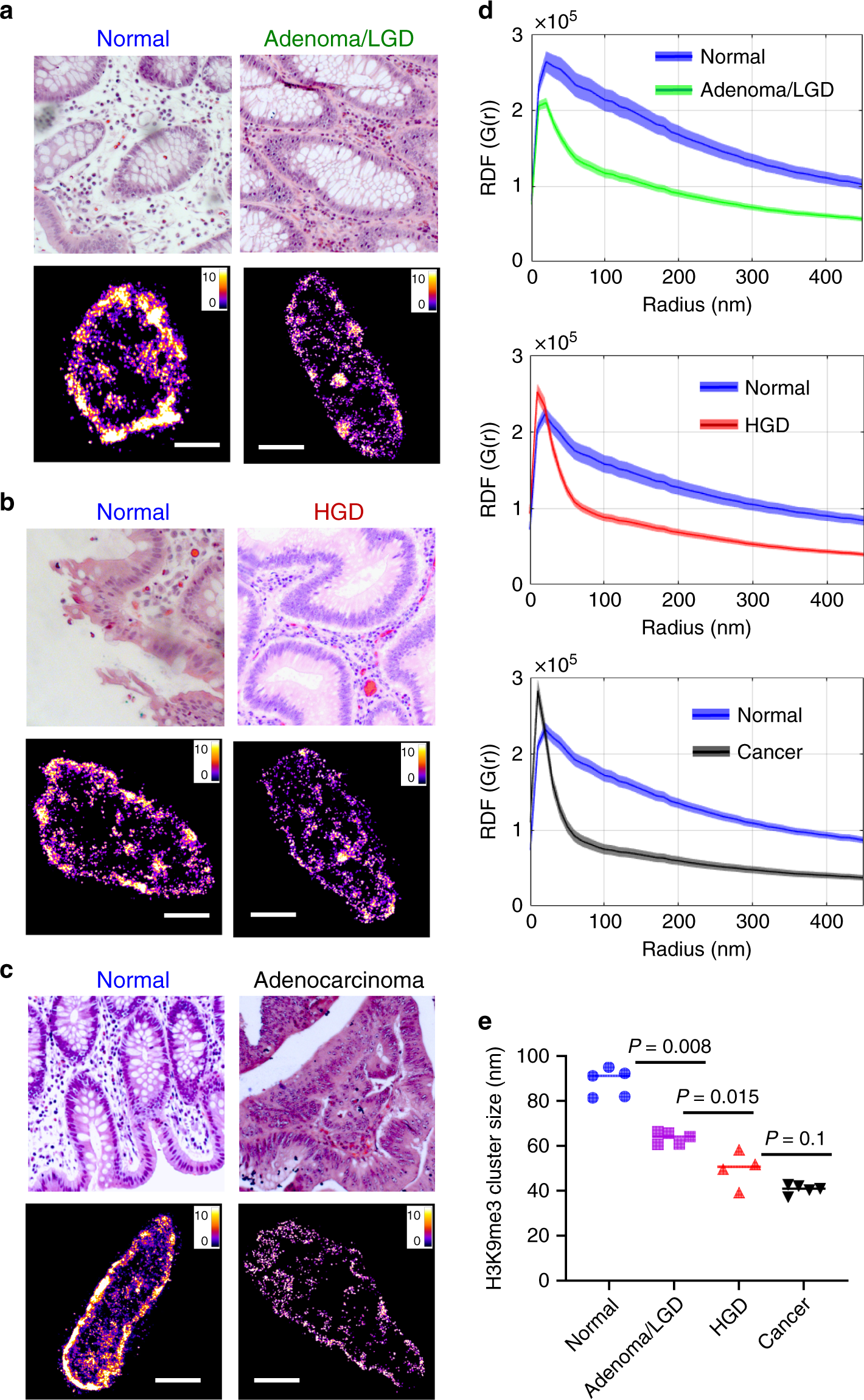 Fig. 6: Super-resolution imaging of disrupted heterochromatin structure in human neoplasia.