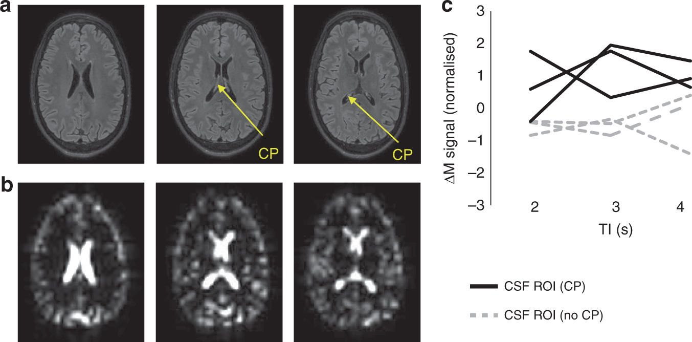 Fig. 4: Non-invasive MRI of BCSFB function: proof of application to the human brain at 3T.