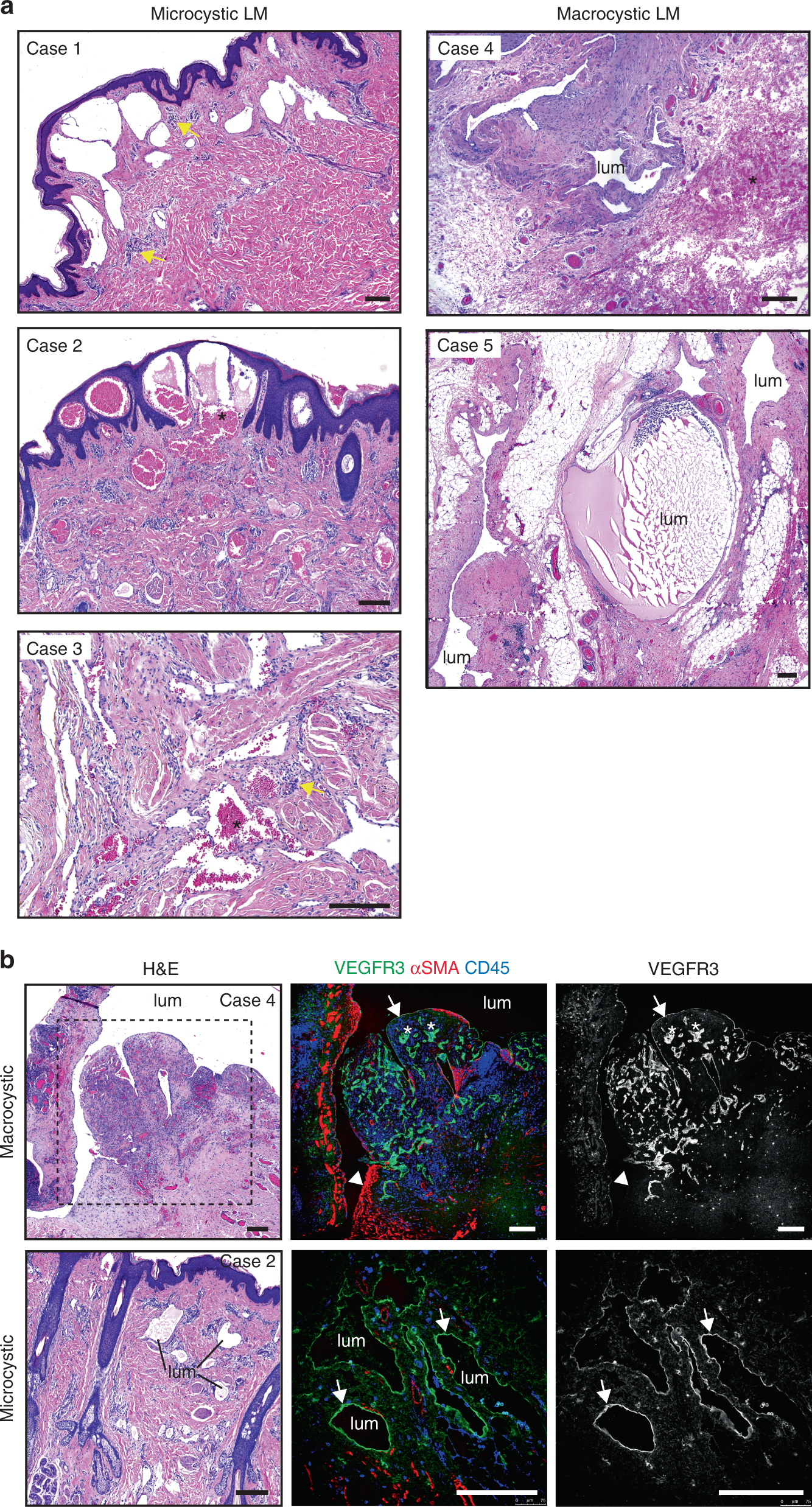 Blockade of VEGF-C signaling inhibits lymphatic malformations driven by  oncogenic PIK3CA mutation | Nature Communications