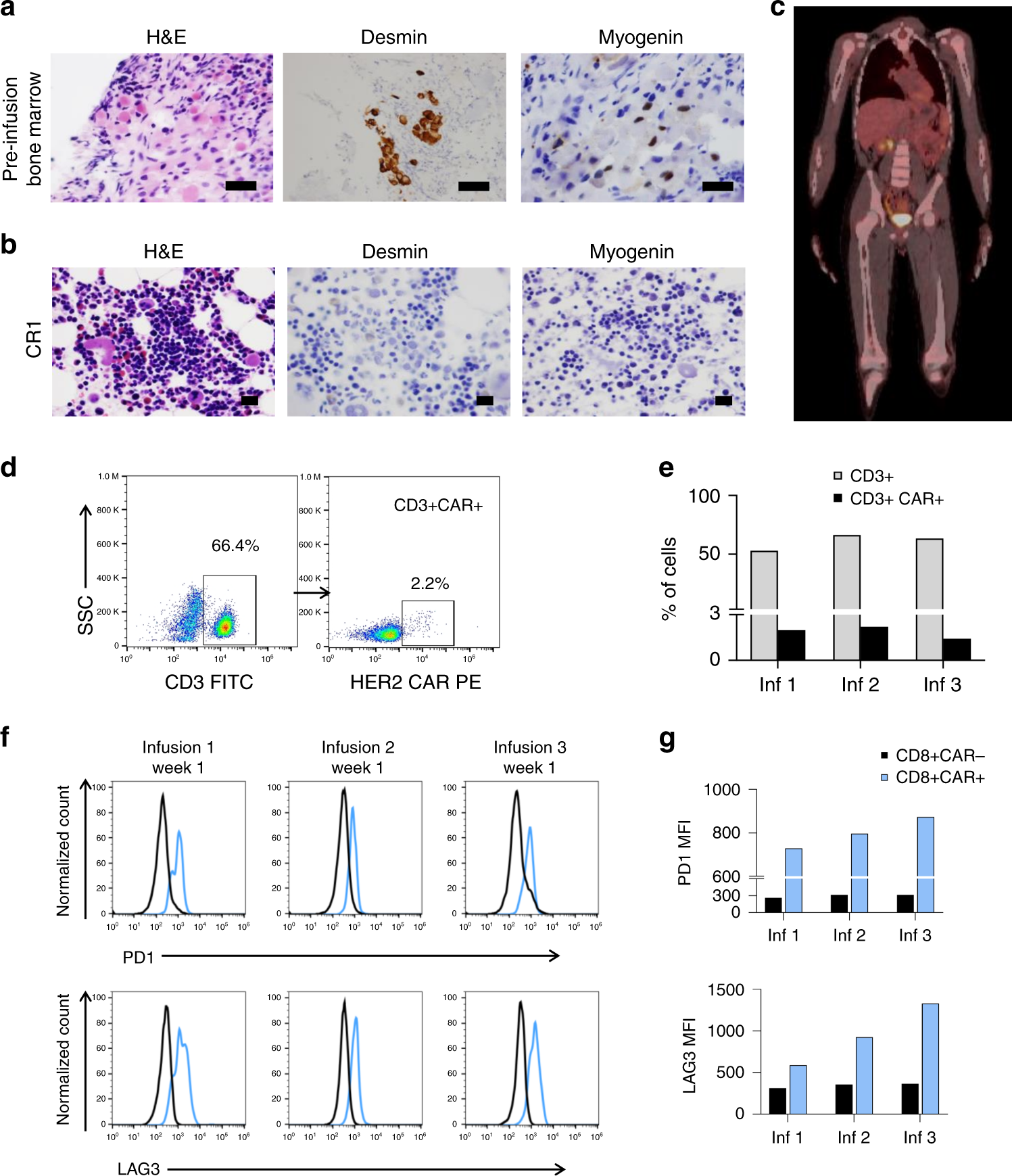 Fig. 3: Clinical and pathological findings after autologous HER2 CAR T-cell infusions.