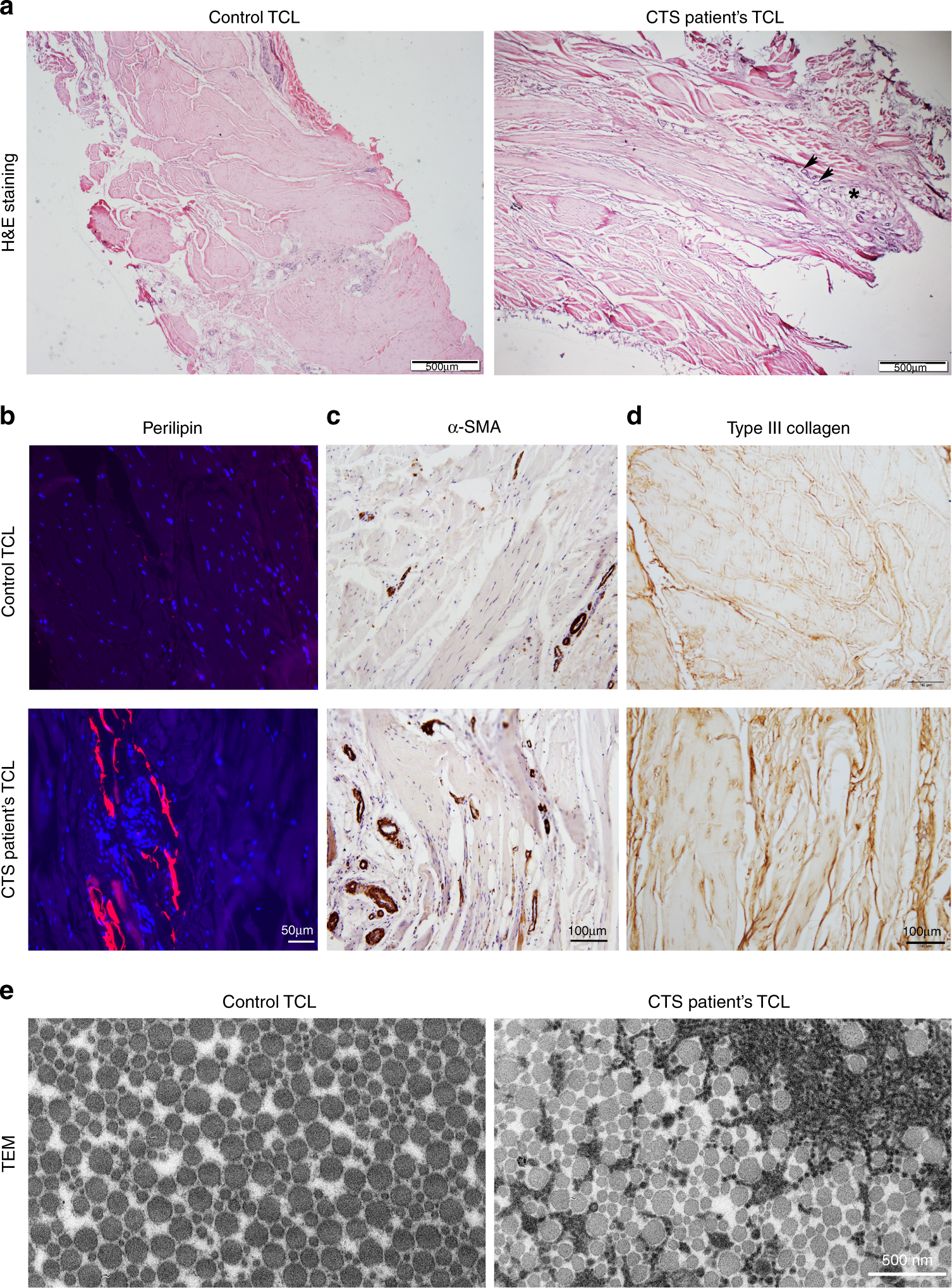 Fig. 2: Histological analysis of CTS patients’ biopsies.