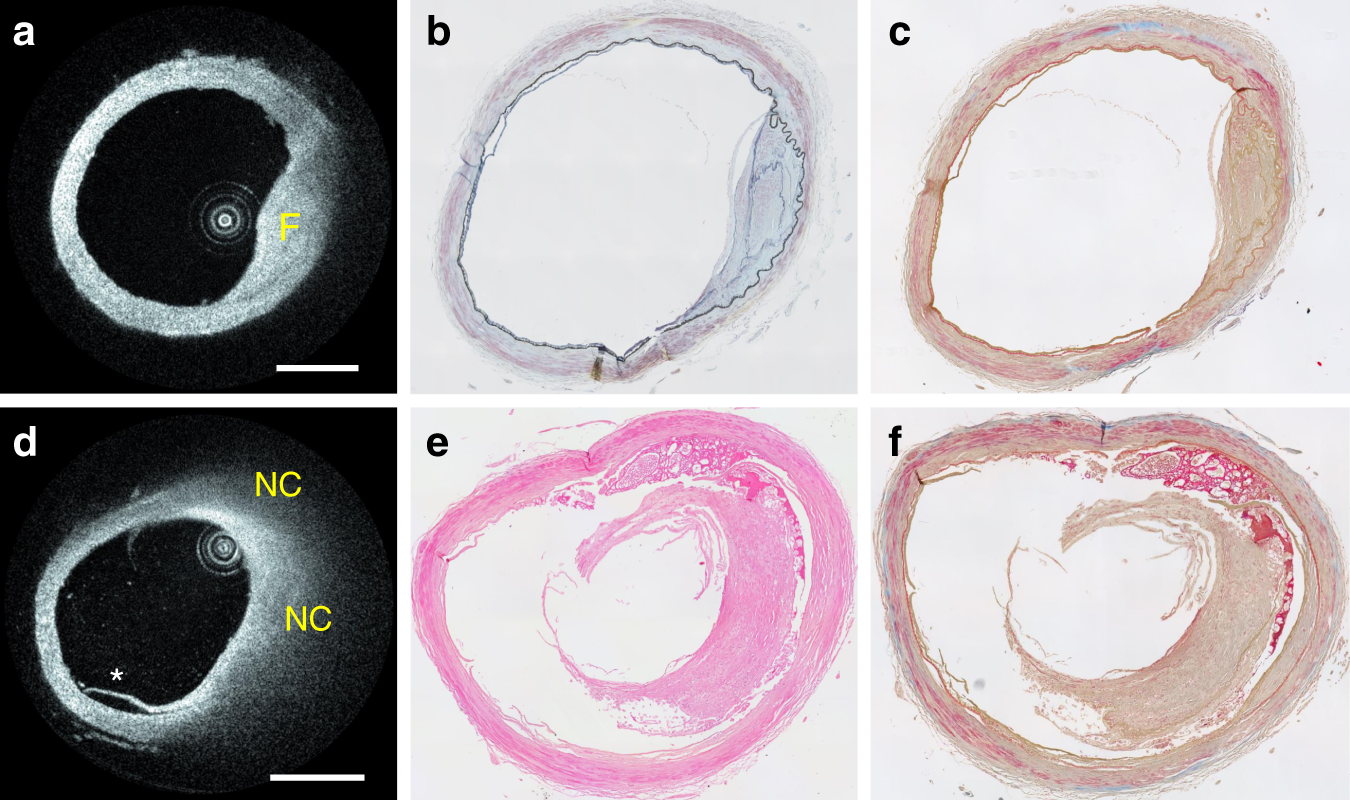 Fig. 7: Intracranial plaques from an ex vivo segment of the MCA artery.