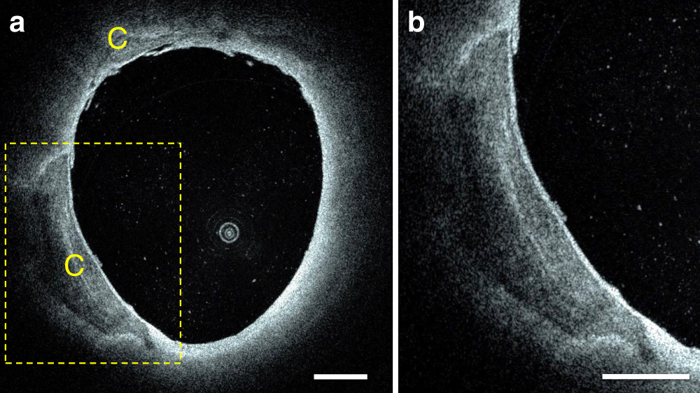 Fig. 8: Intracranial fibrocalcific plaques in a segment of an intradural vertebral artery.
