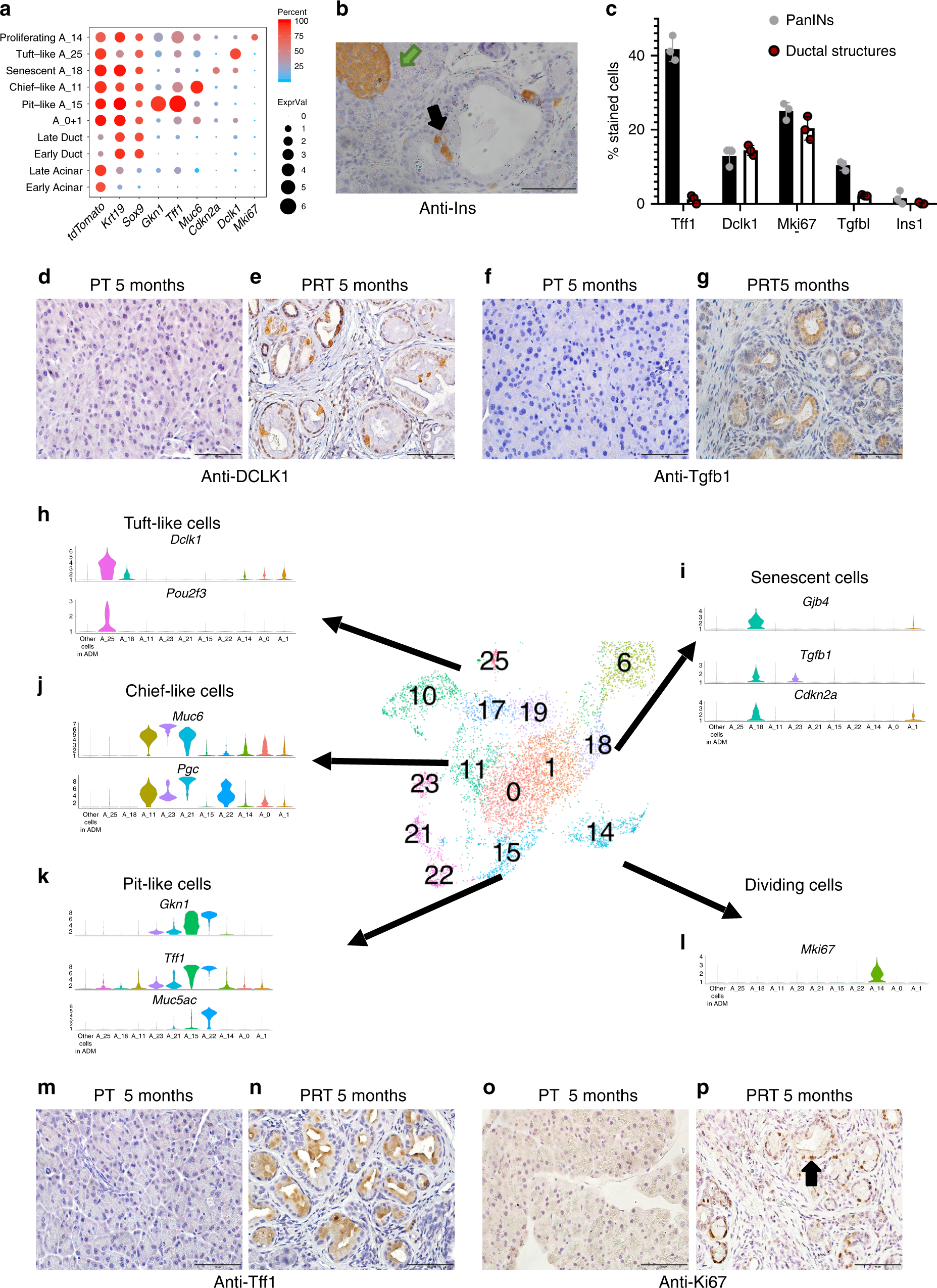 Fig. 4: Acinar metaplastic cells are heterogeneous.