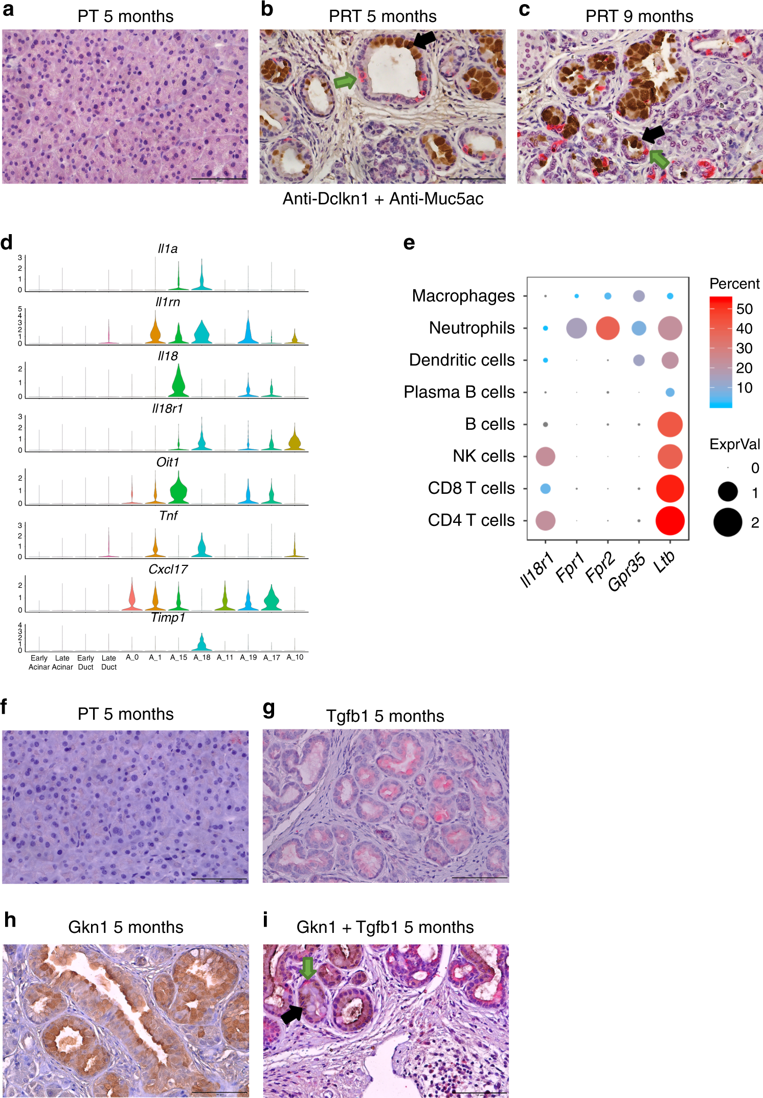 Fig. 5: Potential metaplastic cell–cell interactions and co-localization of different metaplastic cell types to the same PanINs.