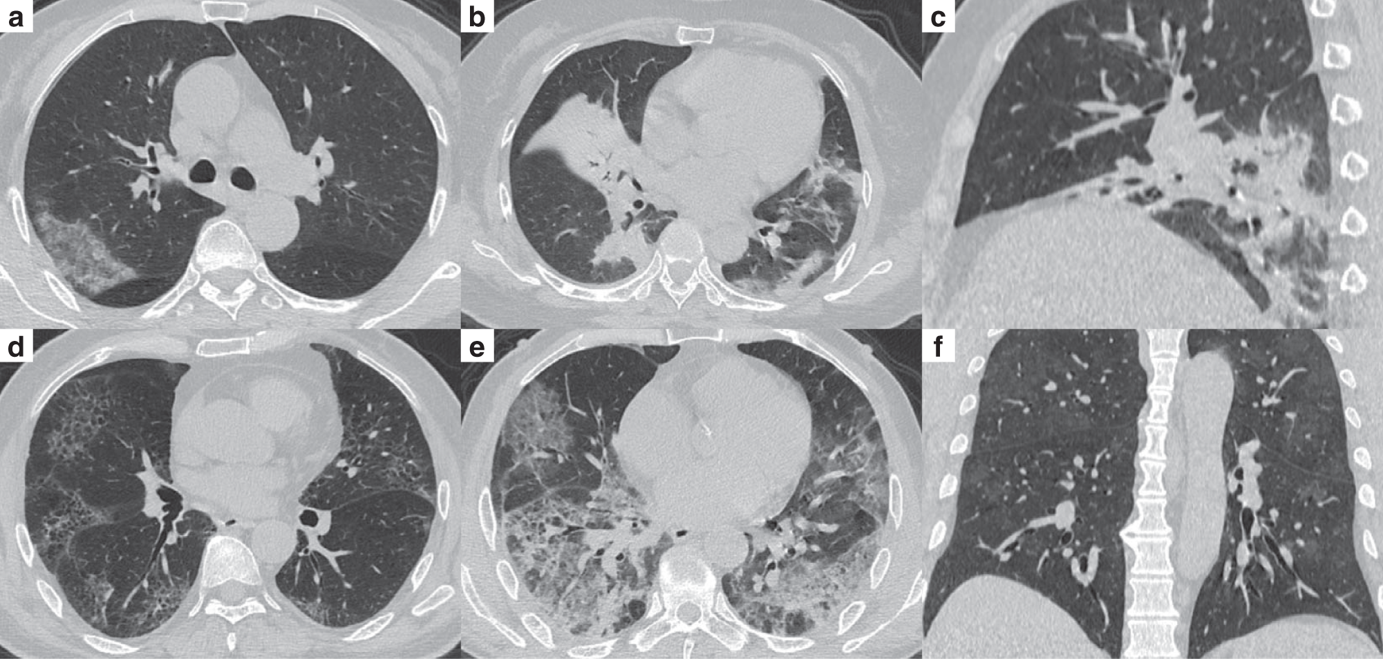 Fig. 2: Representative chest CT images of patients with COVID-19 pneumonia.