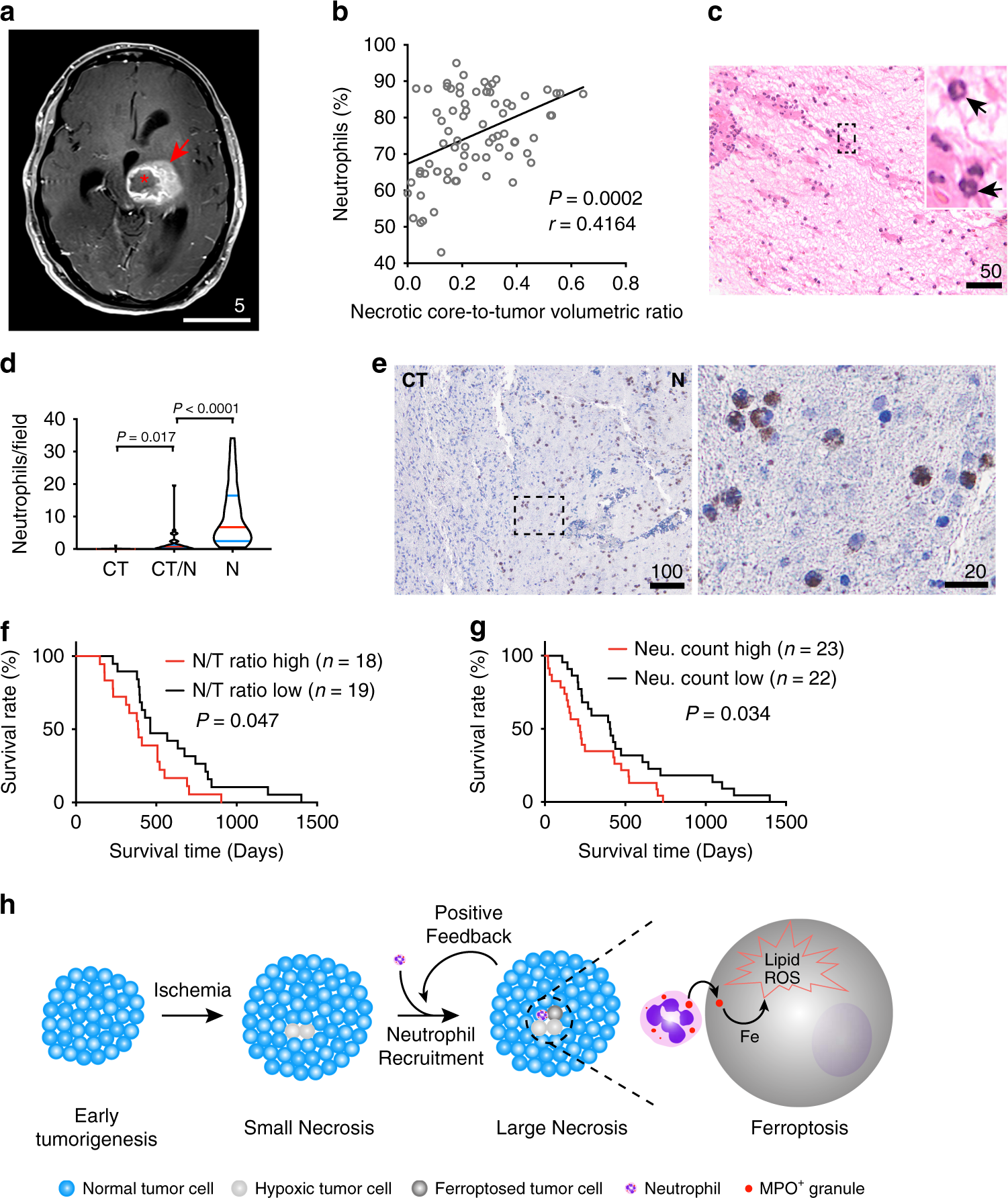 Fig. 8: Tumor-associated neutrophils, both peripherally and intra-tumorally, are closely associated with tumor necrosis in human GBMs and shorter survivals.
