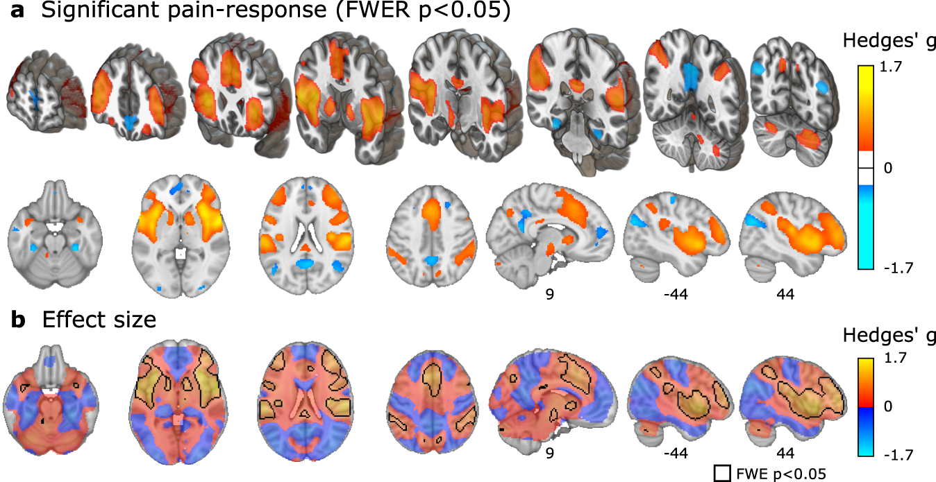 Meta-analysis of neural systems underlying placebo analgesia from  individual participant fMRI data | Nature Communications