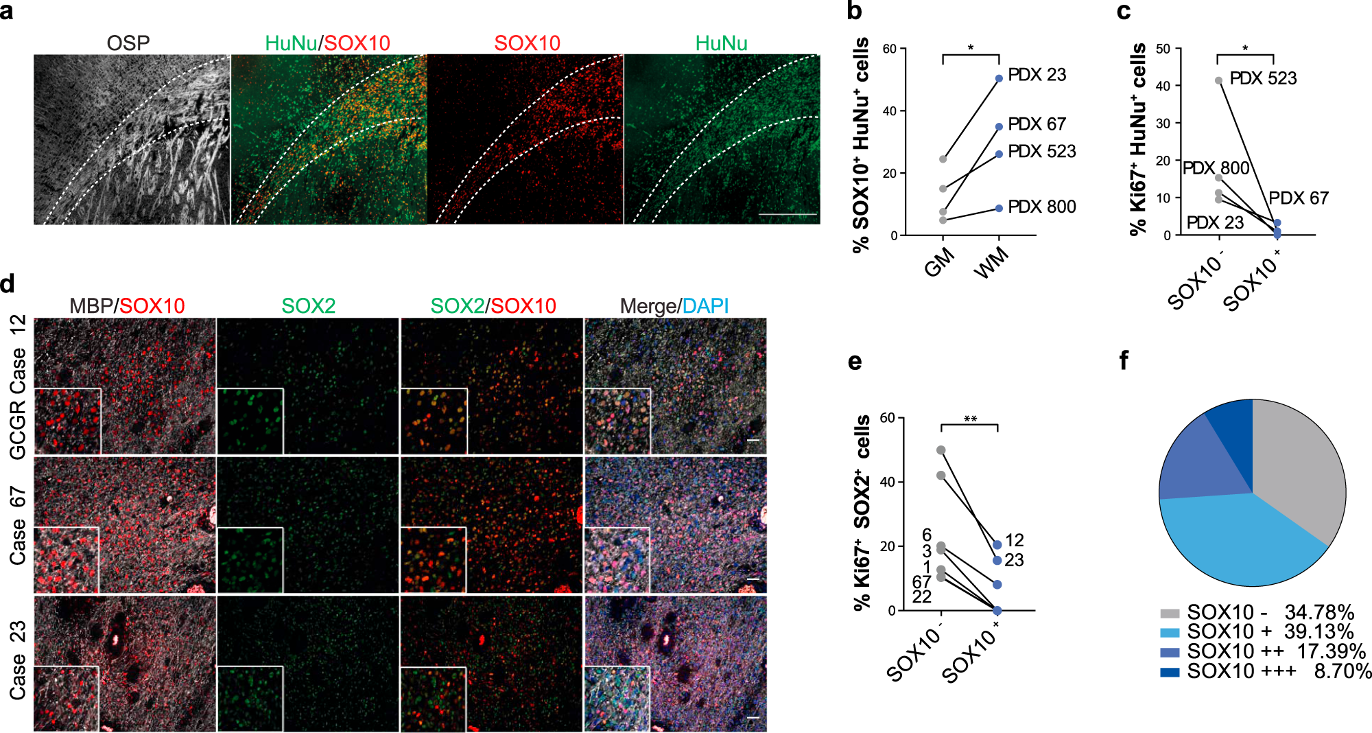 Fig. 2: Differentiation in white matter is a general GBM response.