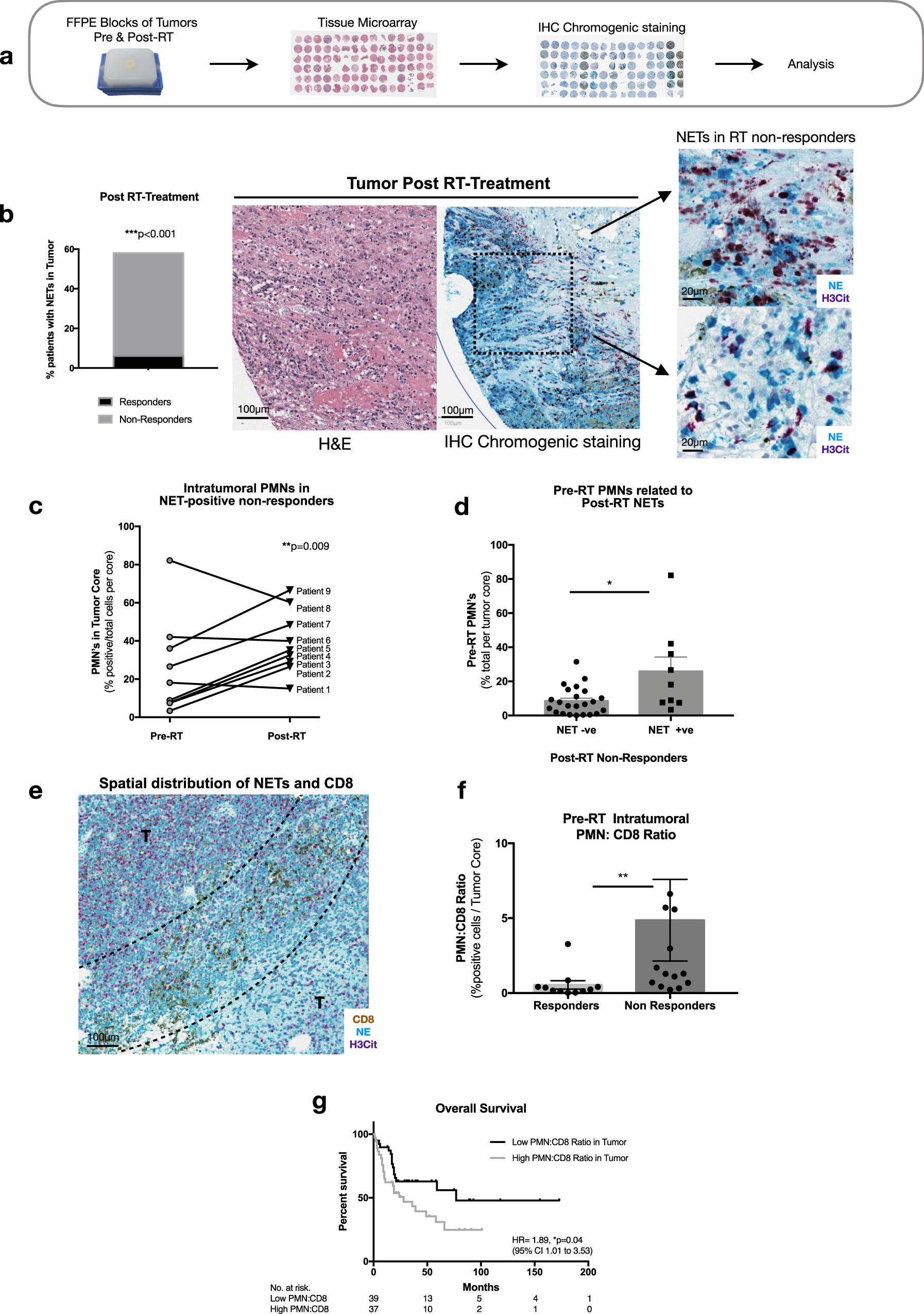 Fig. 6: NETs are present in human MIBC tumors and a high PMN to CD8 ratio is associated with worse overall survival.