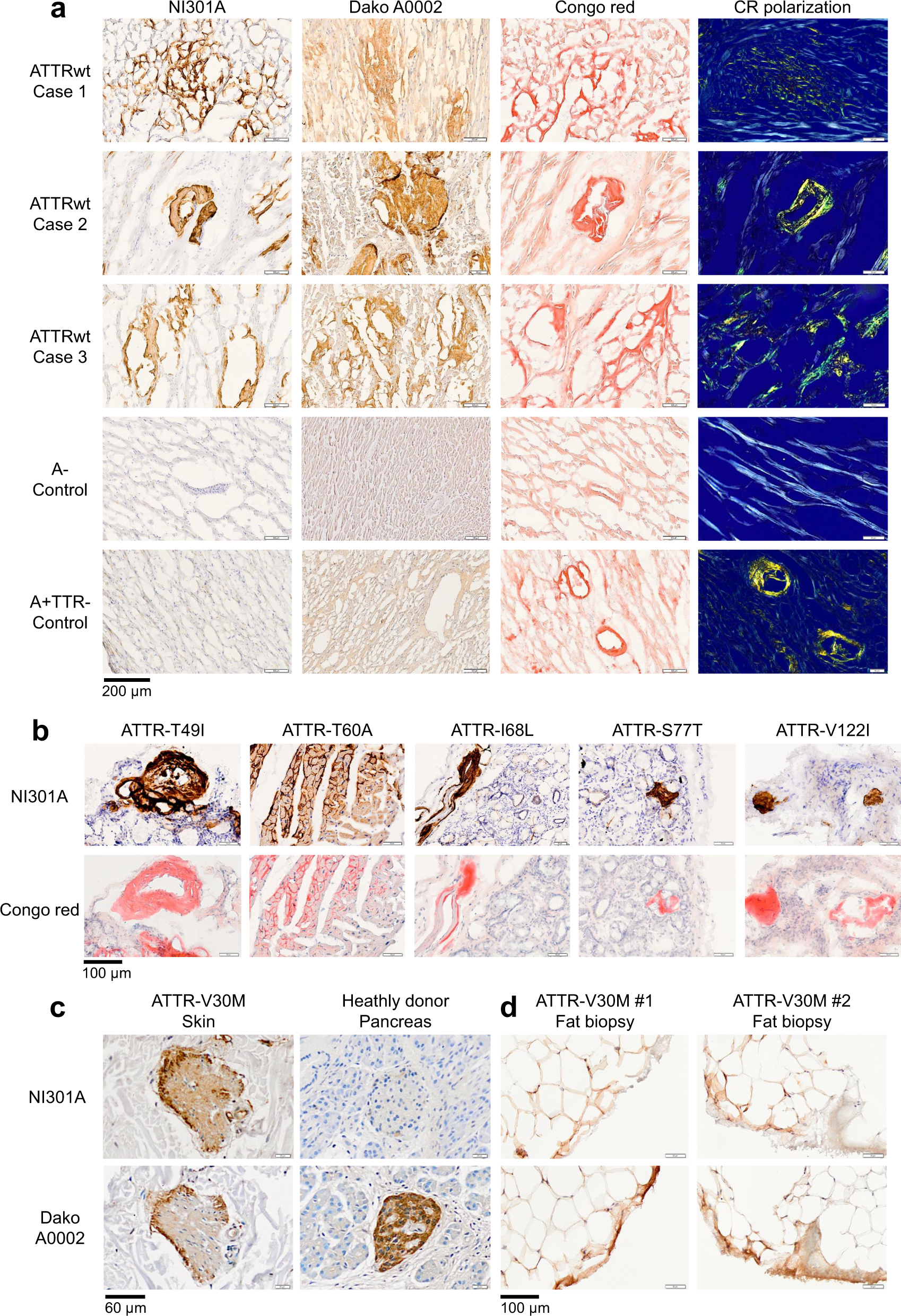 Fig. 2: NI301A binds TTR amyloid present in sporadic and hereditary cases of ATTR amyloidosis with cardiomyopathy and polyneuropathy.