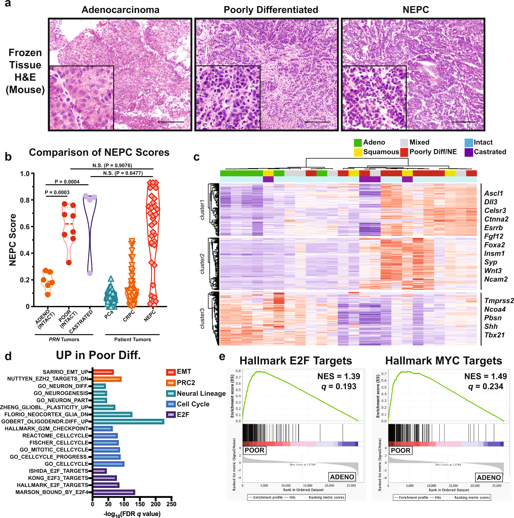 Fig. 2: Poorly differentiated tumors have molecular signatures similar to clinical NEPC.