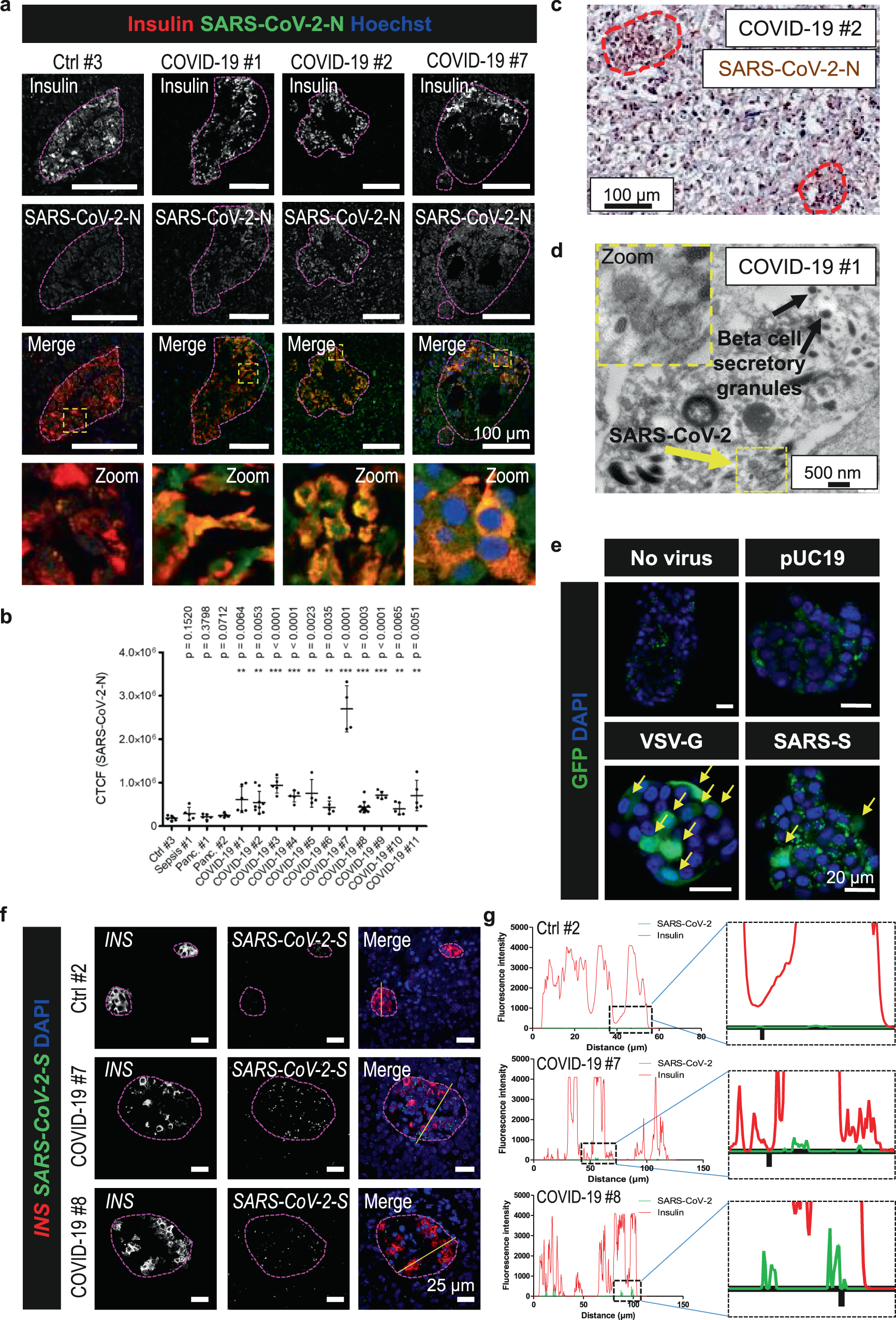 Viral Infiltration Of Pancreatic Islets In Patients With Covid 19 Nature Communications