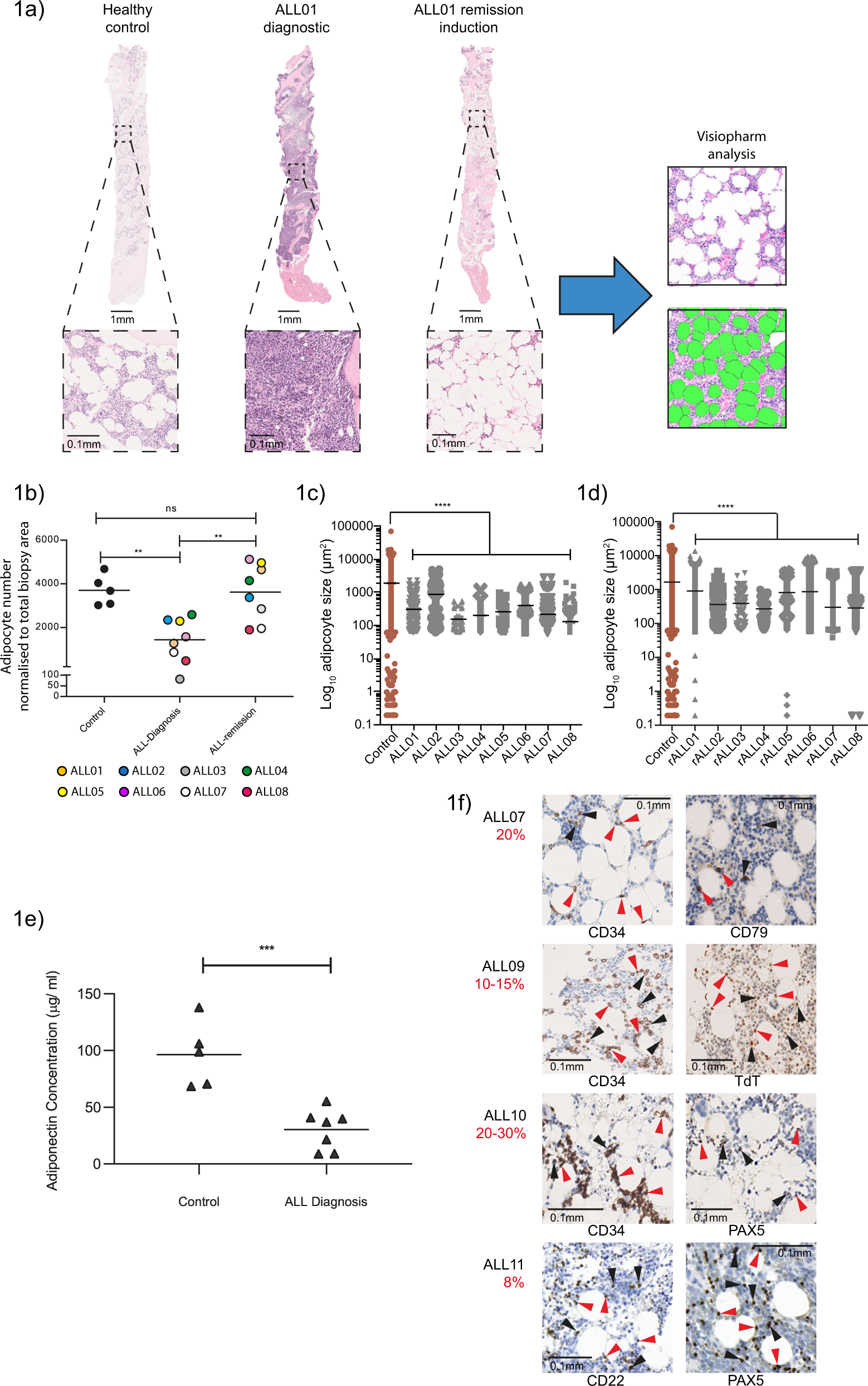 Adipocytes disrupt the translational programme of acute lymphoblastic  leukaemia to favour tumour survival and persistence | Nature Communications