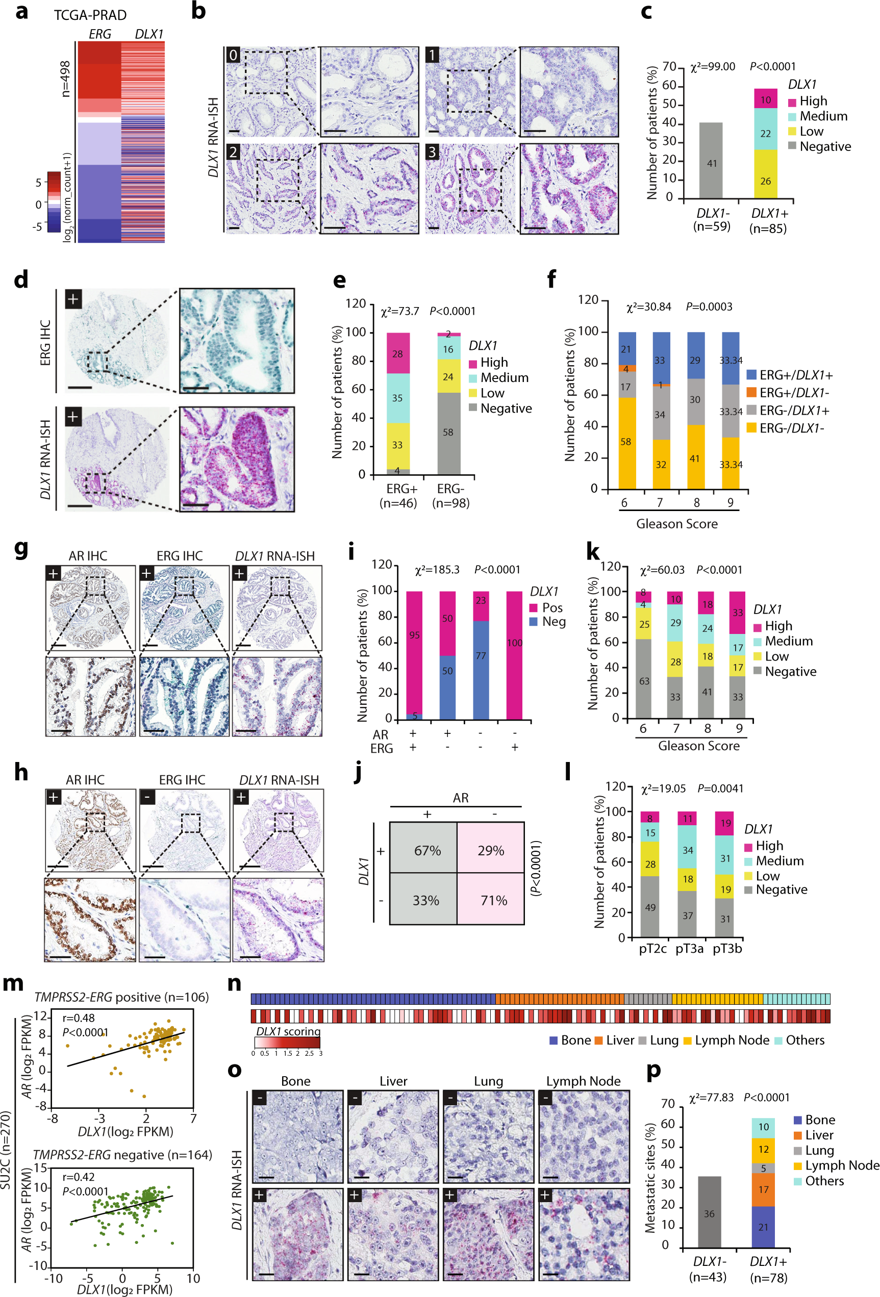 Fig. 4: Elevated ERG and AR correlates with higher DLX1 levels representing advanced-stage aggressive disease.