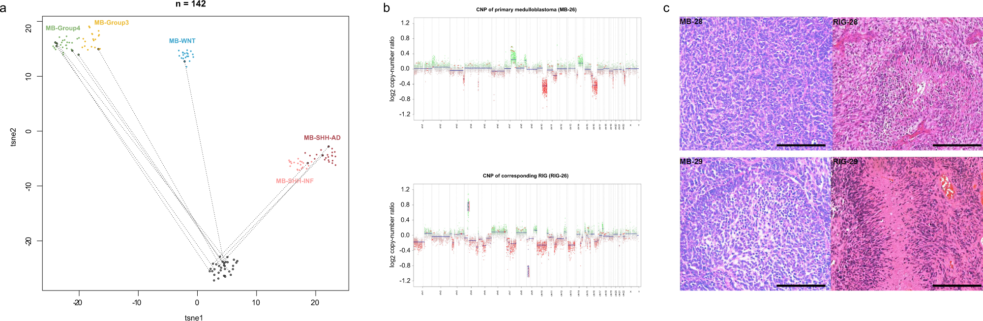 Fig. 4: Comparison of matched primary MB and post-radiation glioma samples.