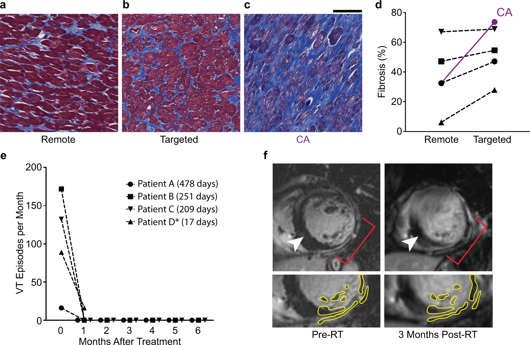 Cardiac radiotherapy induces electrical conduction reprogramming in the  absence of transmural fibrosis | Nature Communications