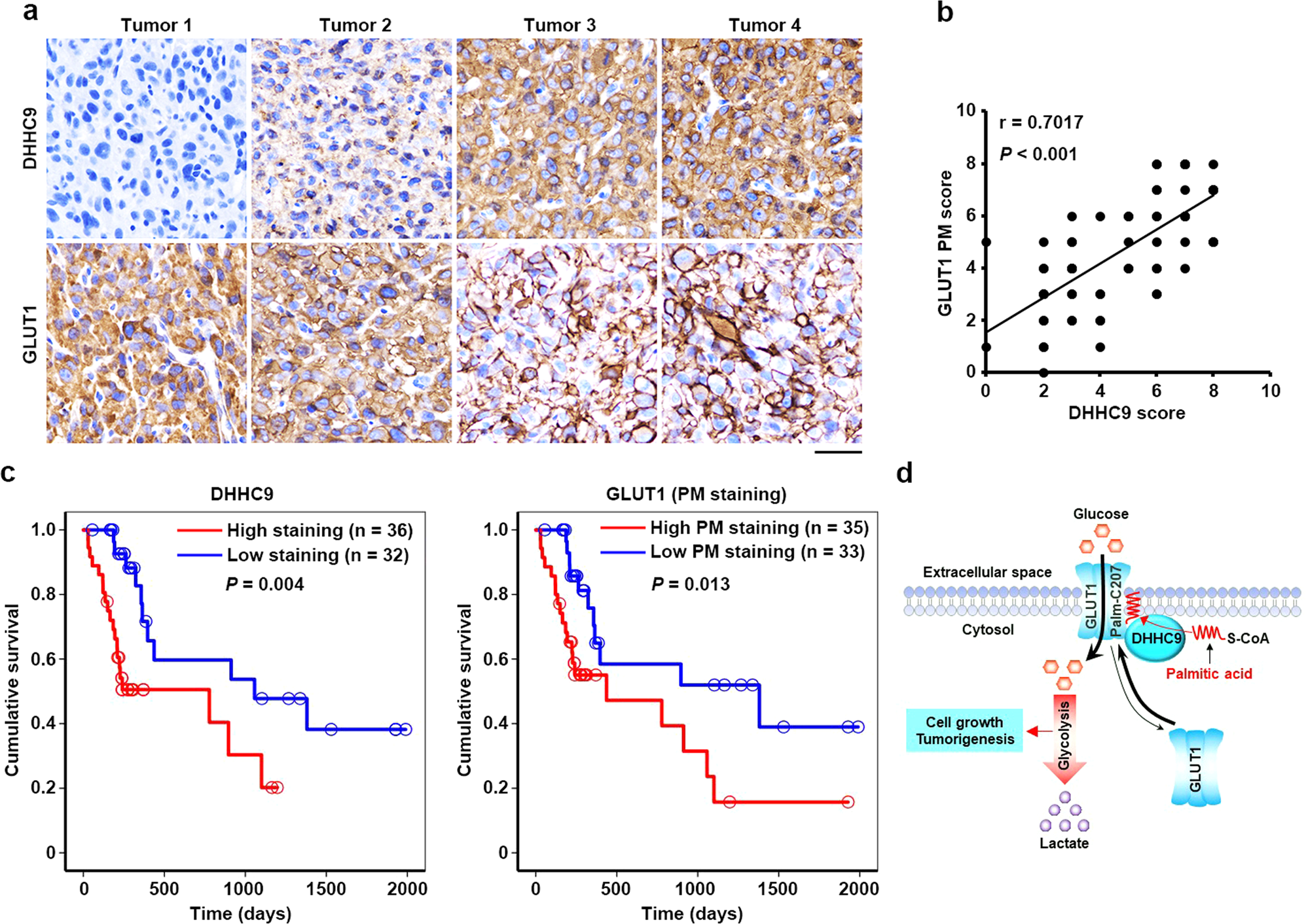 Fig. 6: DHHC9 expression positively correlates with GLUT1 PM localization in GBM specimens and indicates clinical aggressiveness of GBM.