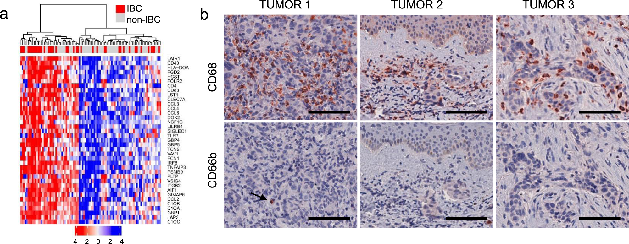 Fig. 10: Macrophages and neutrophils in human IBC.