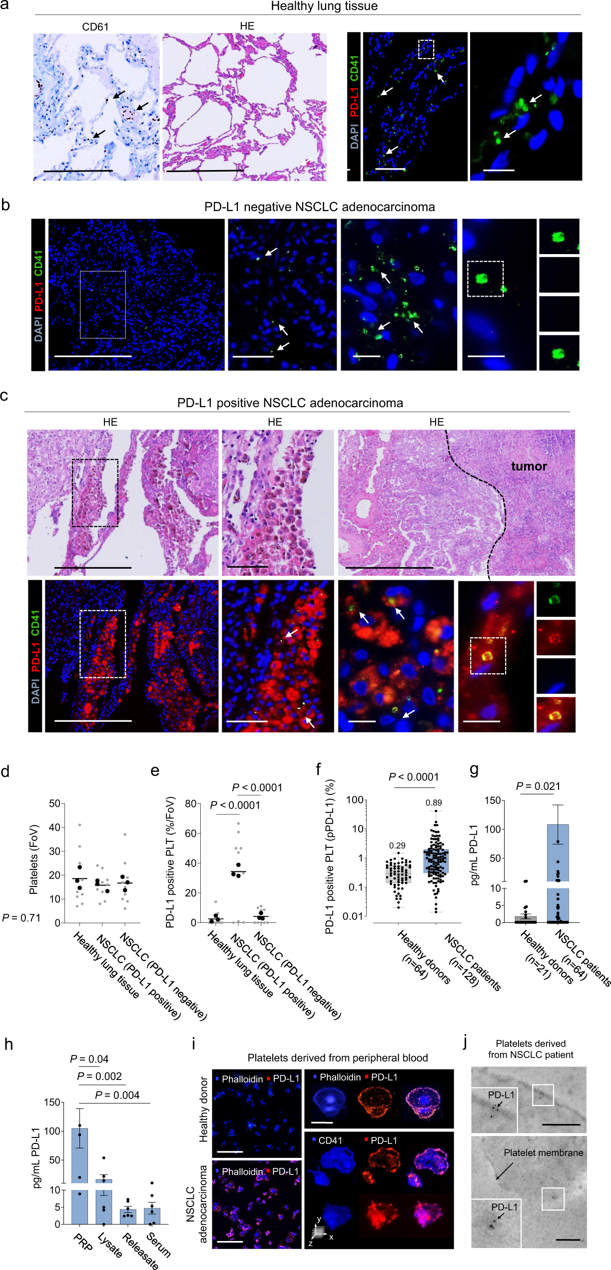 Fig. 3: Platelets from NSCLC patients show increased PD-L1 levels.