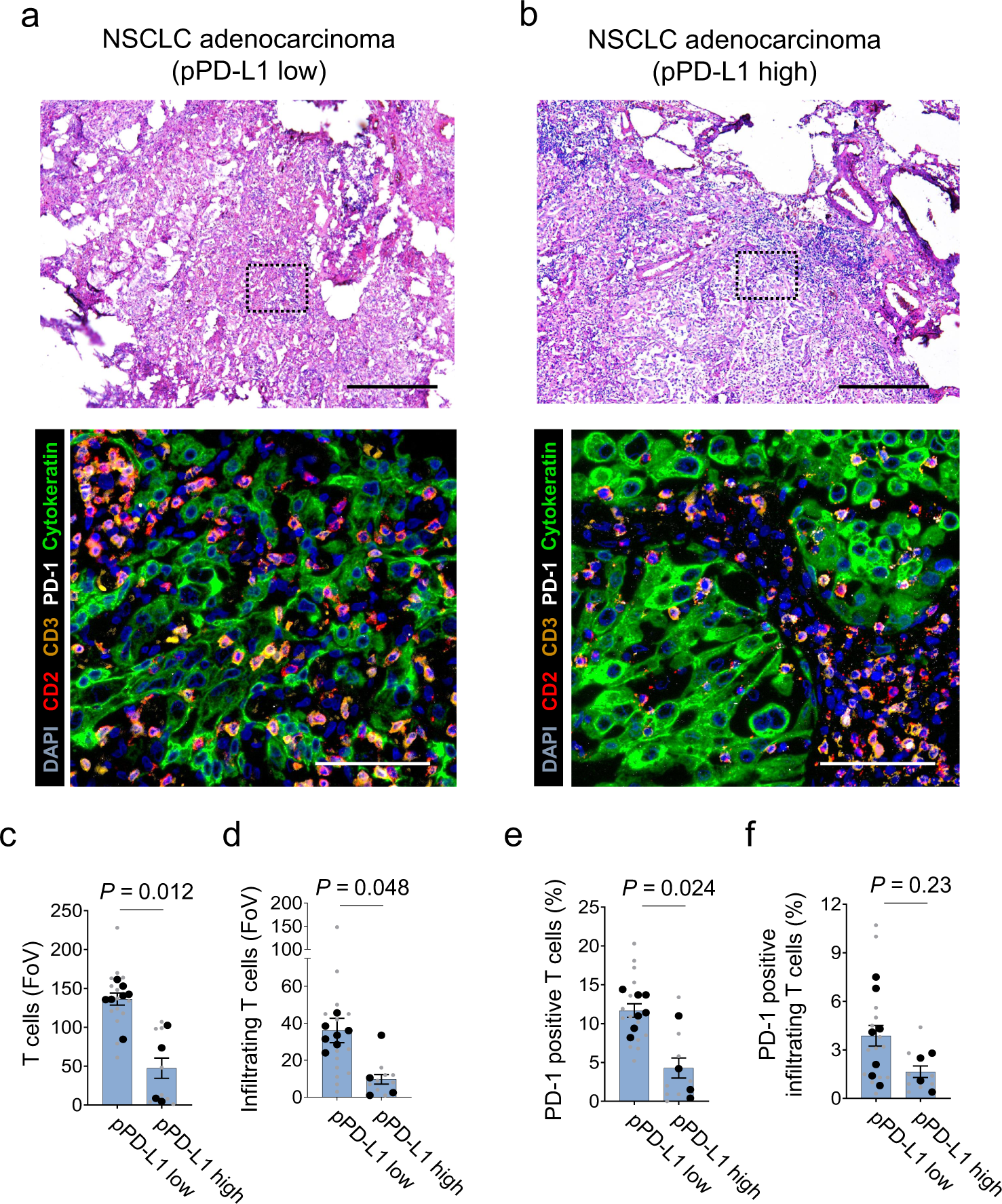 Fig. 5: pPD-L1 correlates with T cell infiltration in NSCLC.